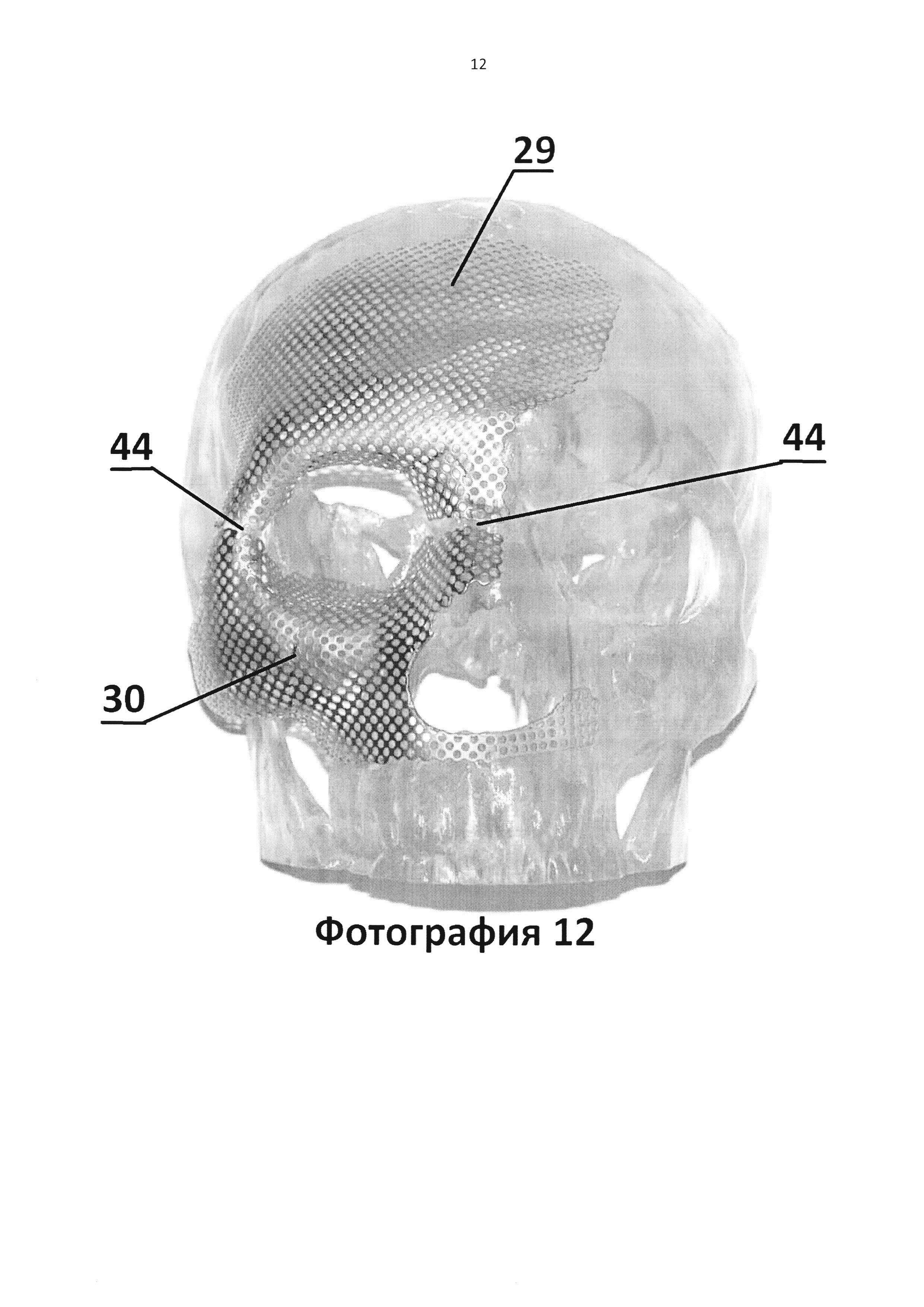 Имплантат для протезирования костей черепа и способ изготовления имплантата для протезирования костей черепа