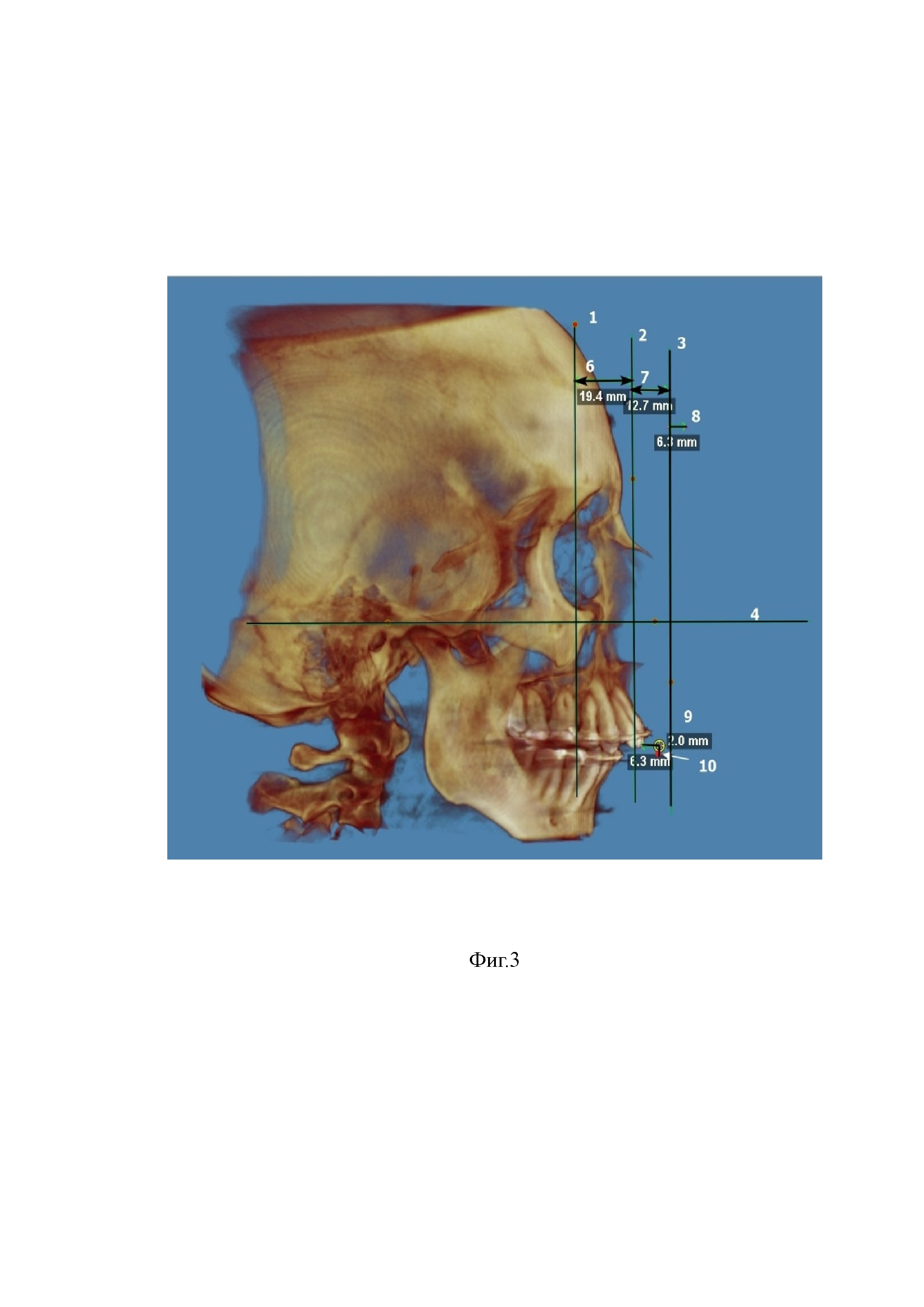 Способ планирования положения верхней челюсти при ортогнатических операциях
