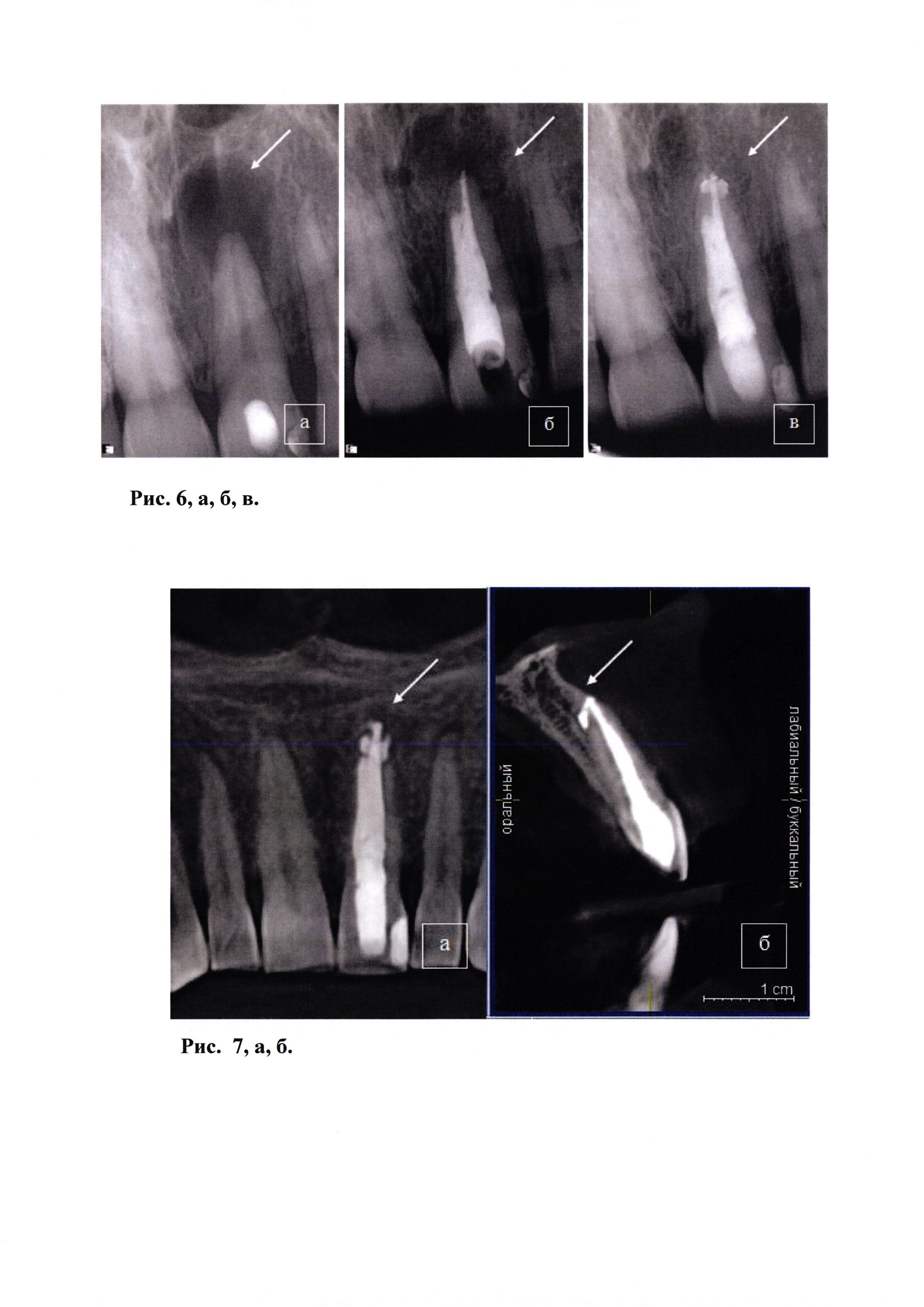 Временное пломбирование корневых каналов. Периапикальная ткань зуба. Разрежение в периапикальных тканях. Цель временного пломбирования корневых каналов.