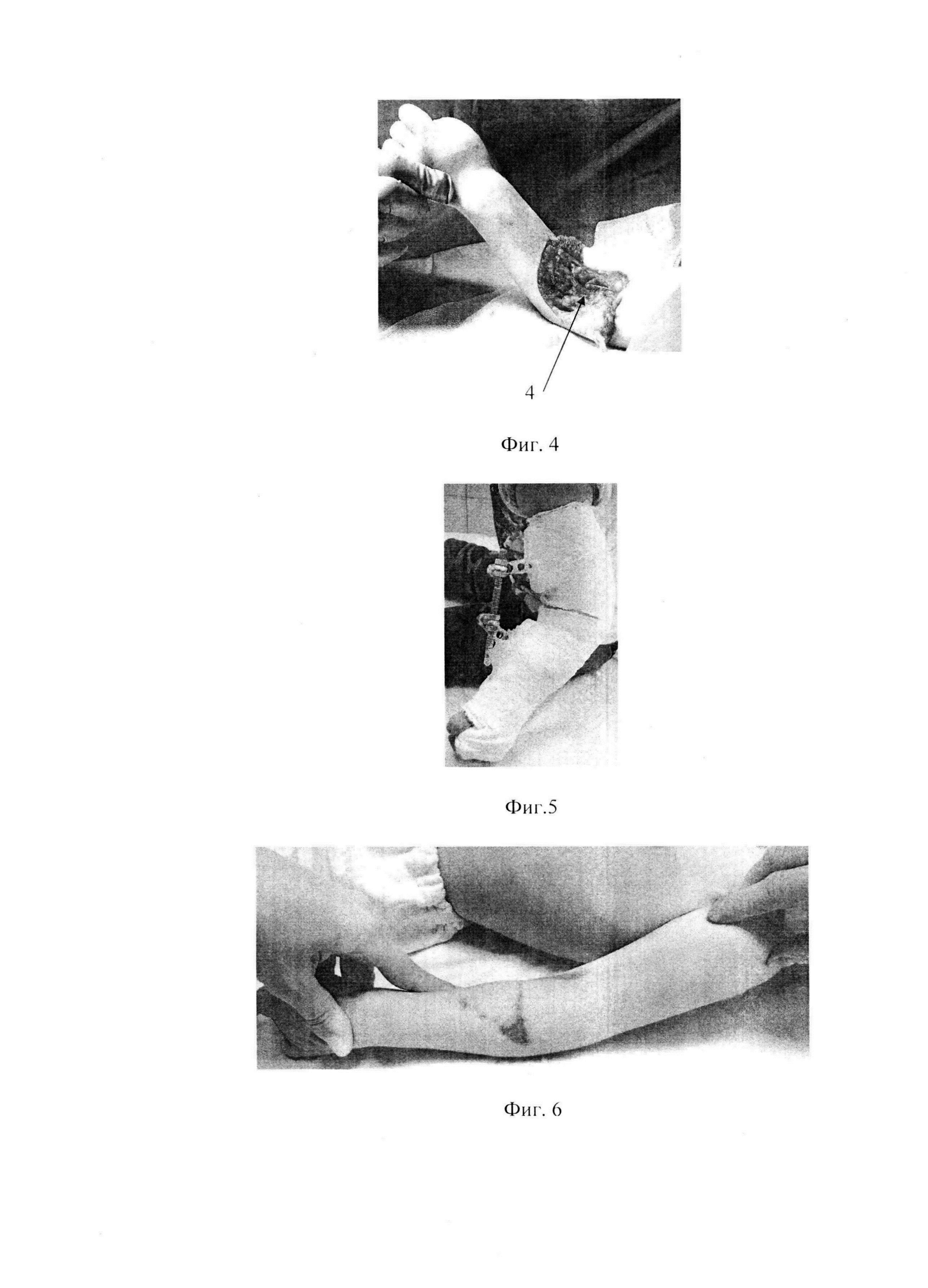 Способ лечения сгибательной контрактуры локтевого сустава у детей с артрогрипозом