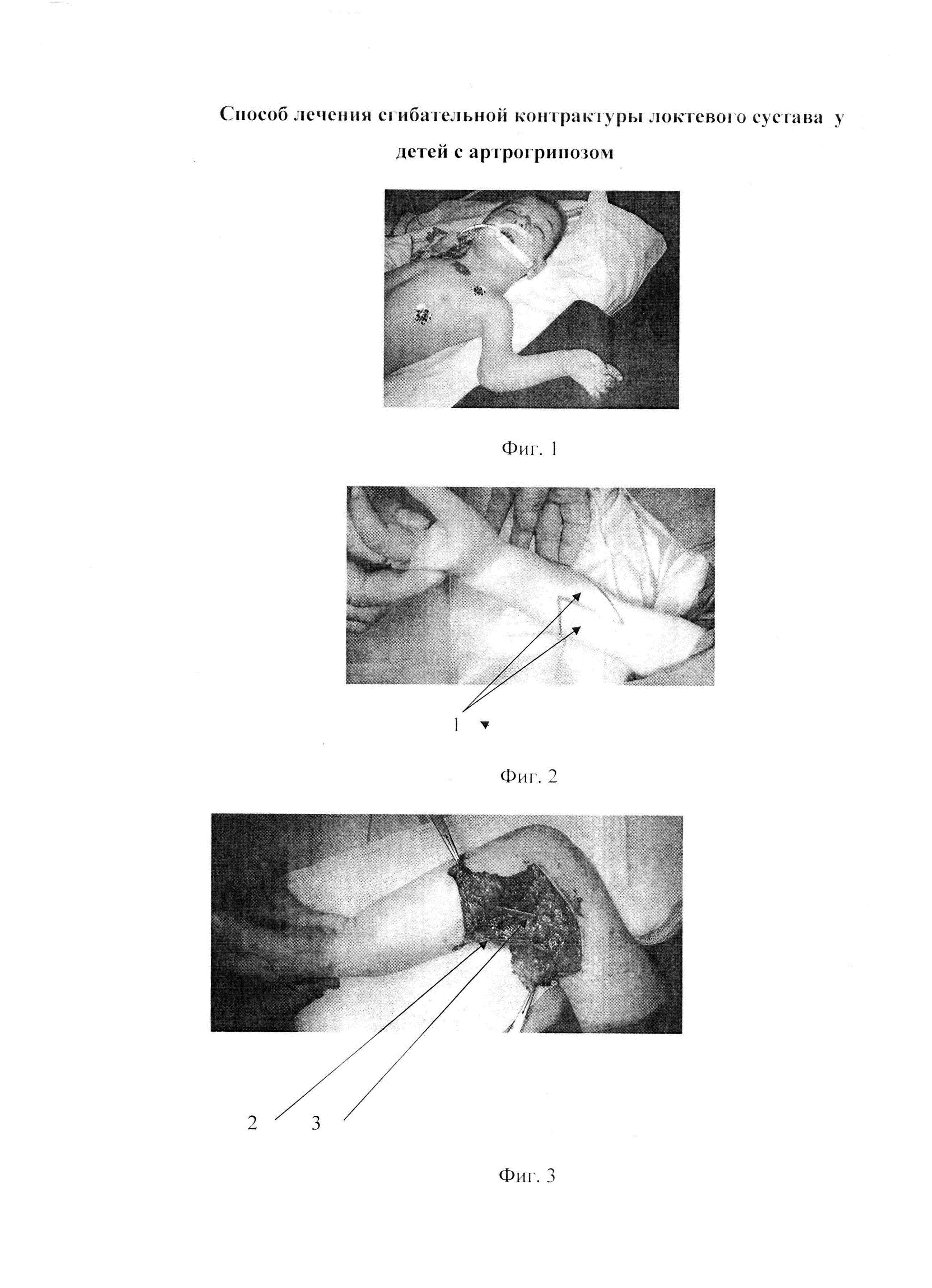 Способ лечения сгибательной контрактуры локтевого сустава у детей с артрогрипозом