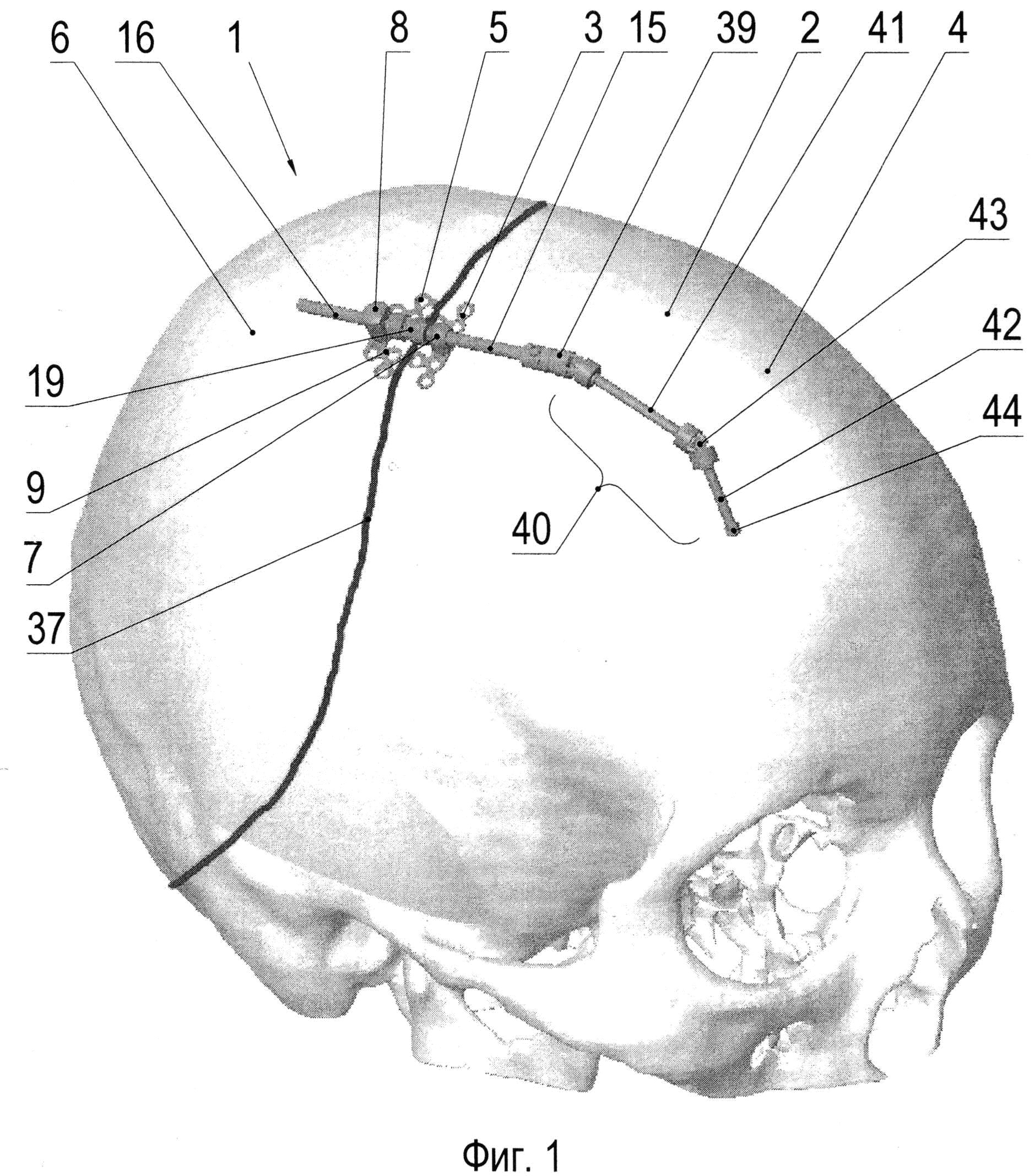 Компрессионно-дистракционный аппарат для устранения деформации черепа, преимущественно явившейся результатом преждевременного заращения черепных швов