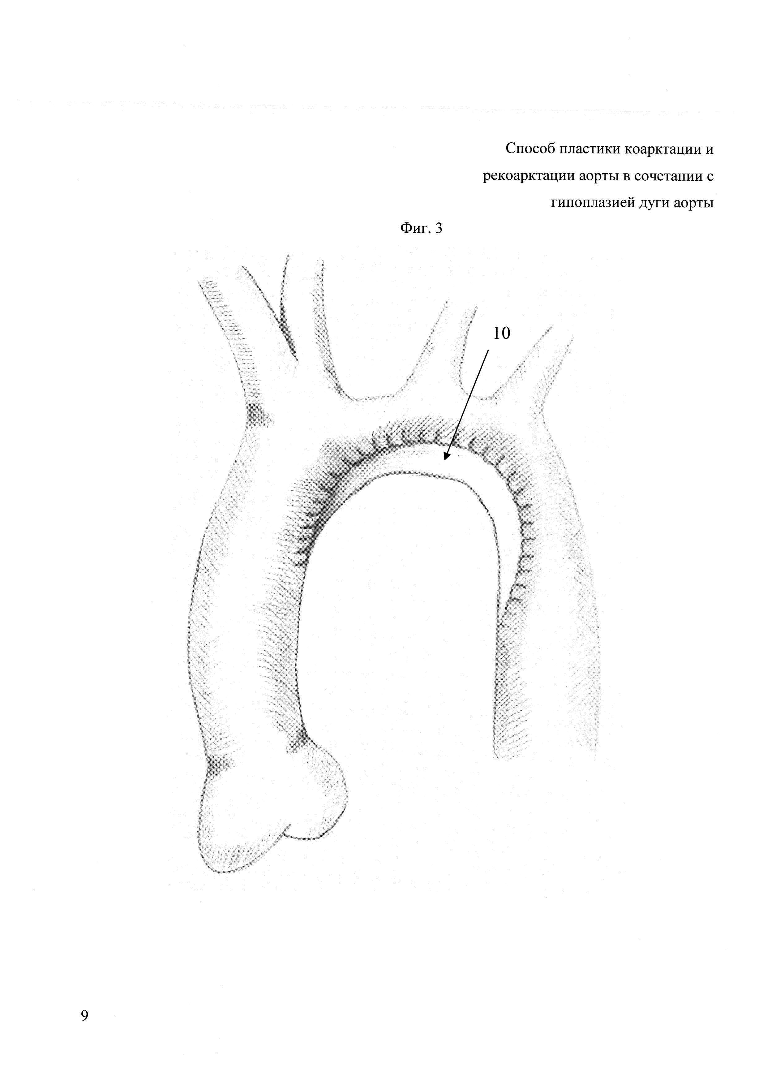 Способ пластики коарктации и рекоарктации аорты в сочетании с гипоплазией дуги аорты