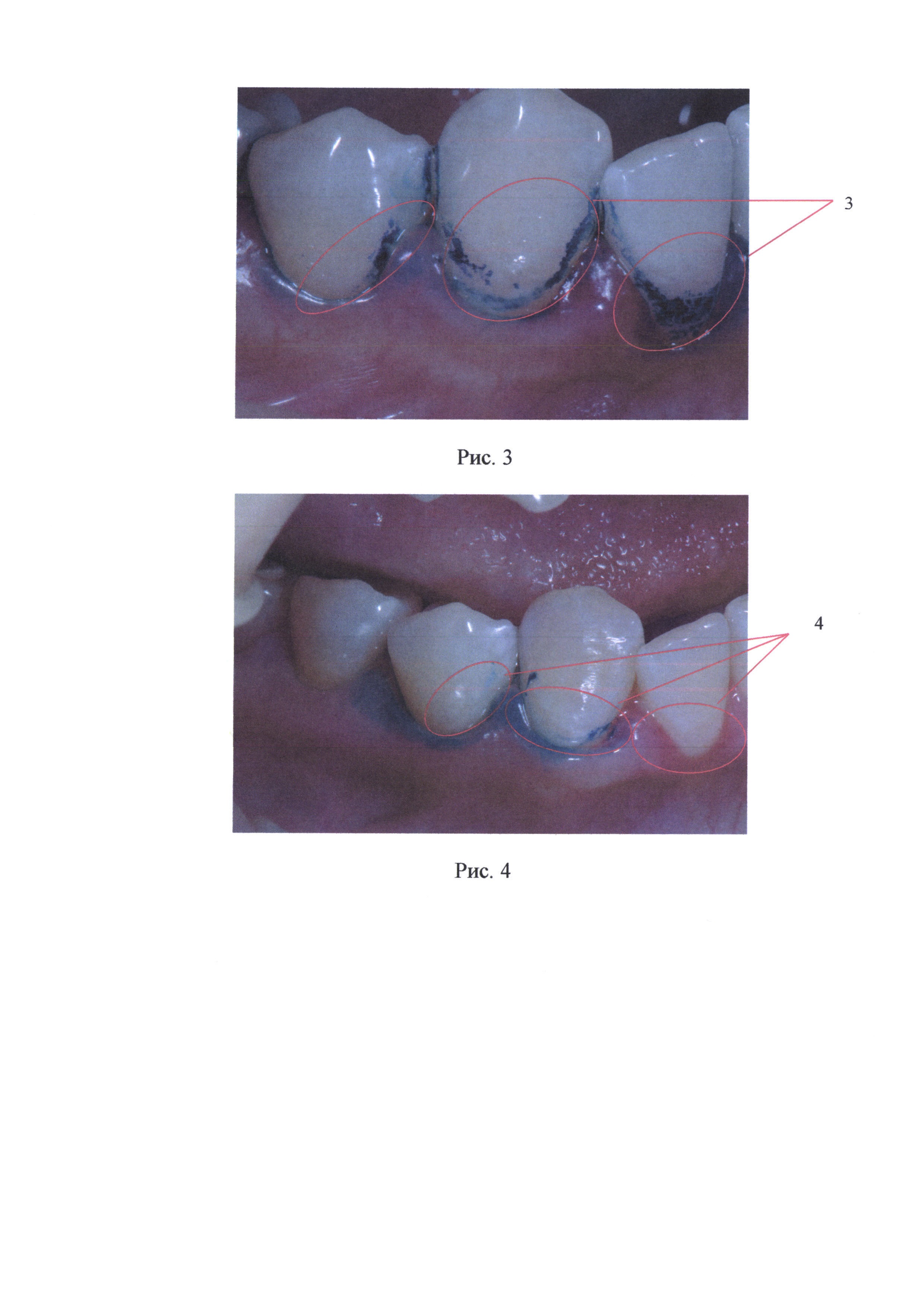 Способ предупреждения поражений твердых тканей зубов кариозной и некариозной этиологии