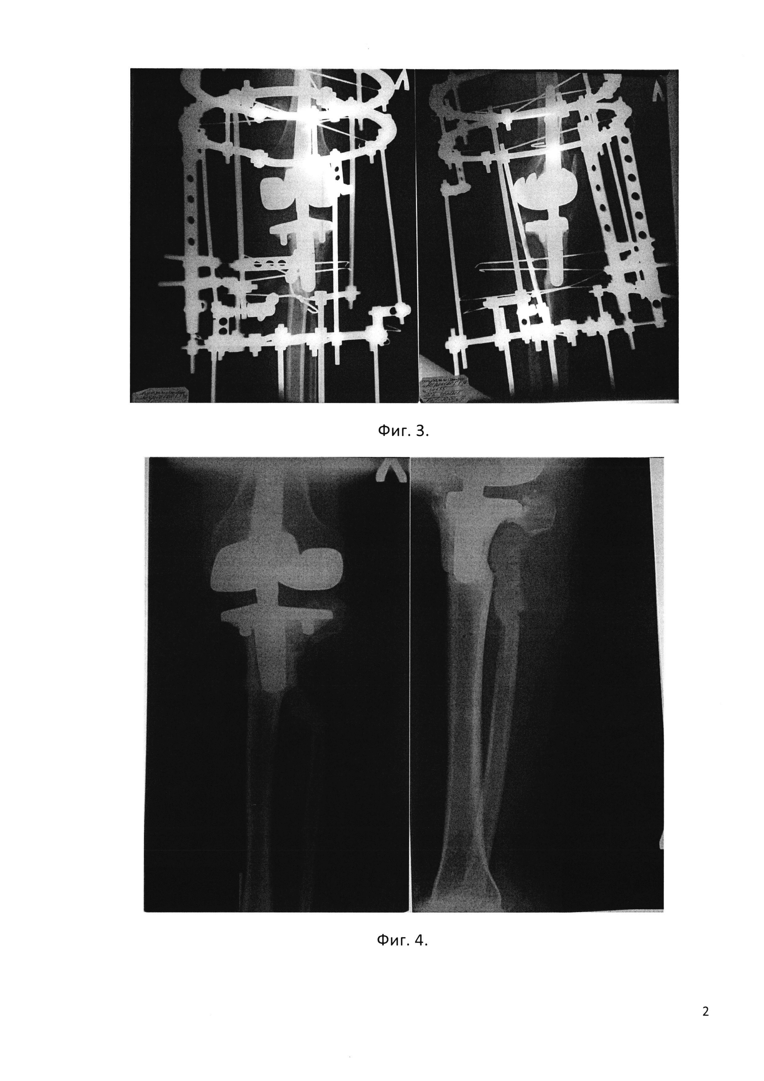 Способ лечения перипротезного перелома большеберцовой кости при остеопорозе