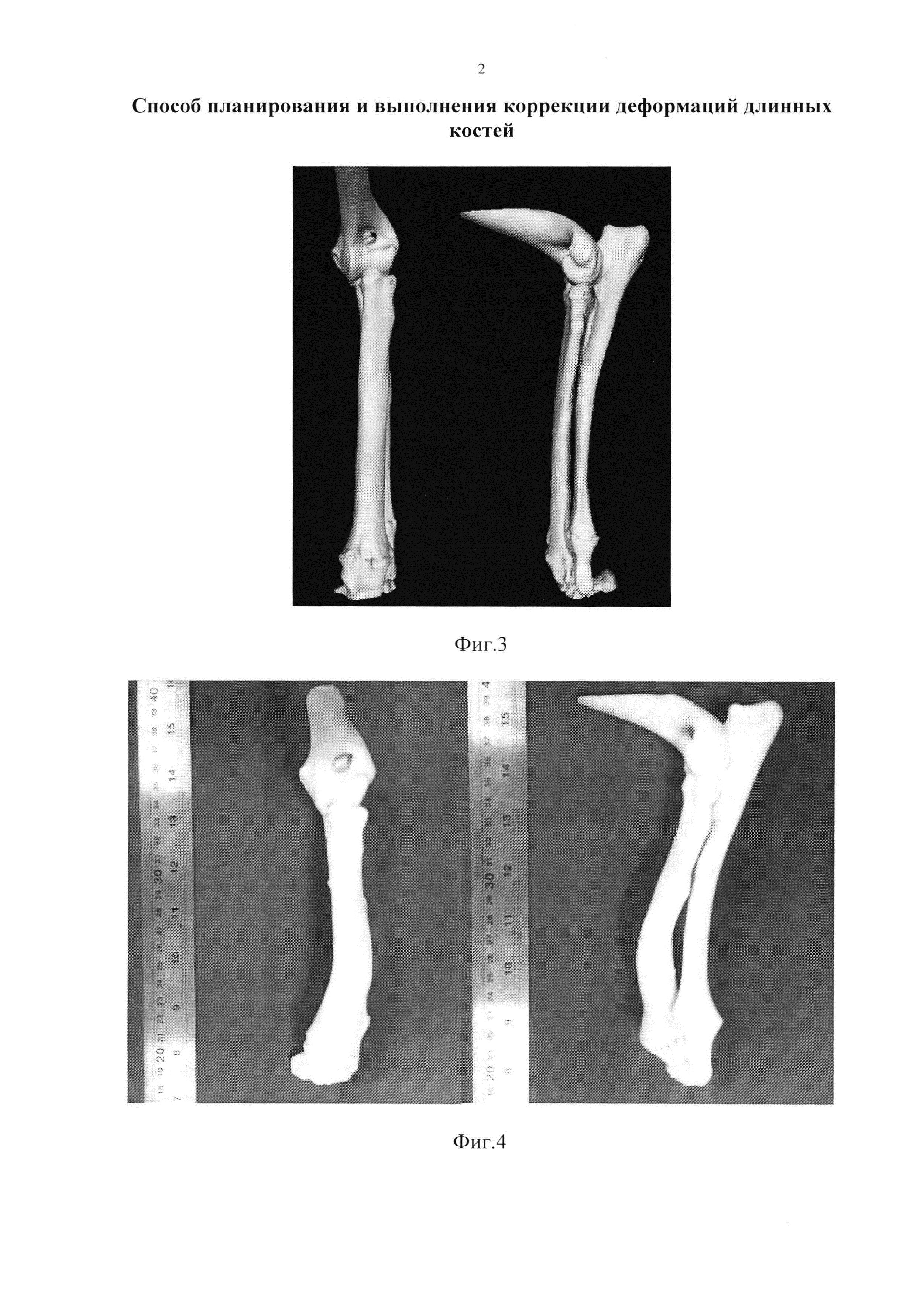 Способ планирования и выполнения коррекции деформаций длинных костей