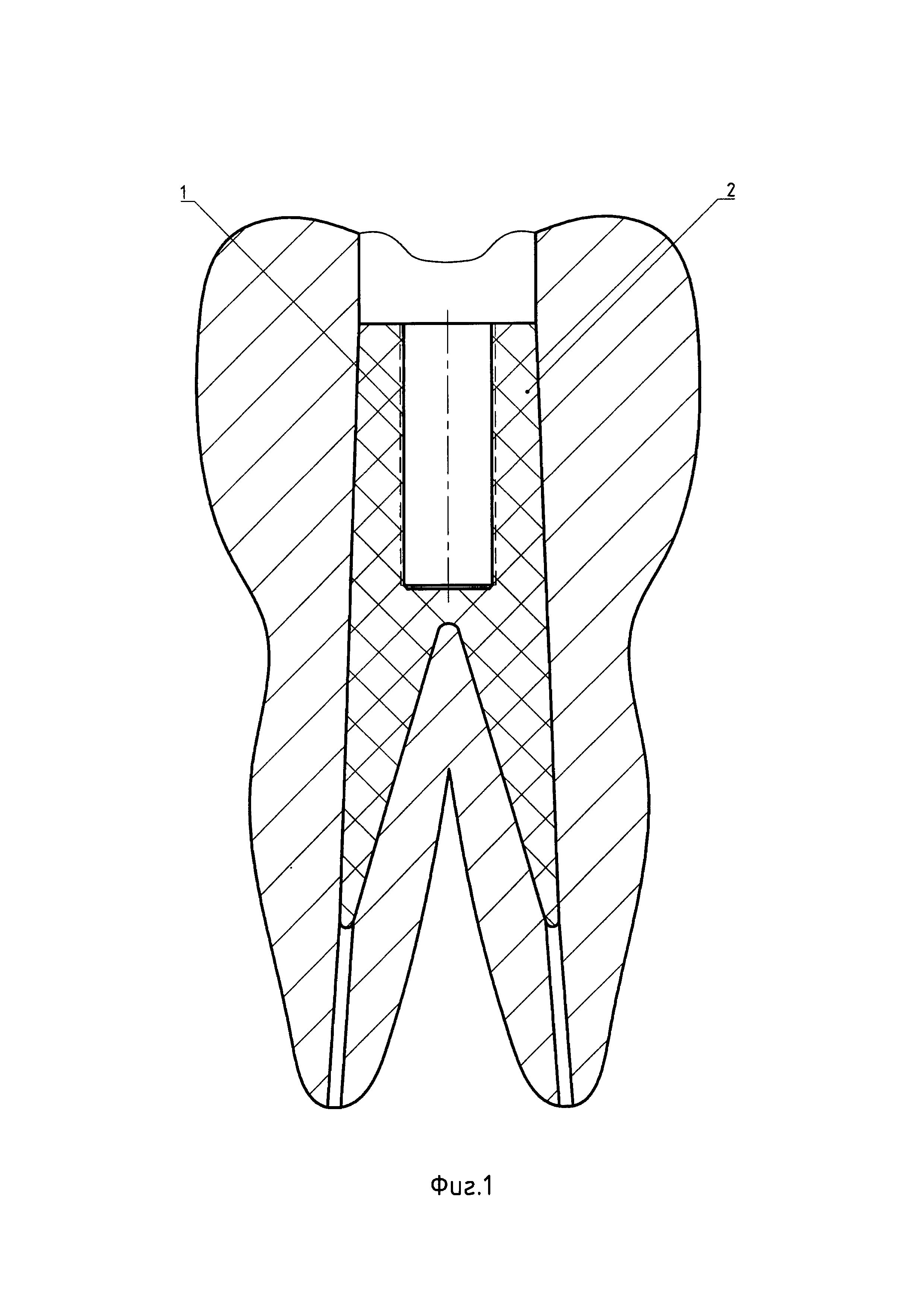 Способ и набор для винтовой фиксации металлокерамических мостовидных протезов к зубам