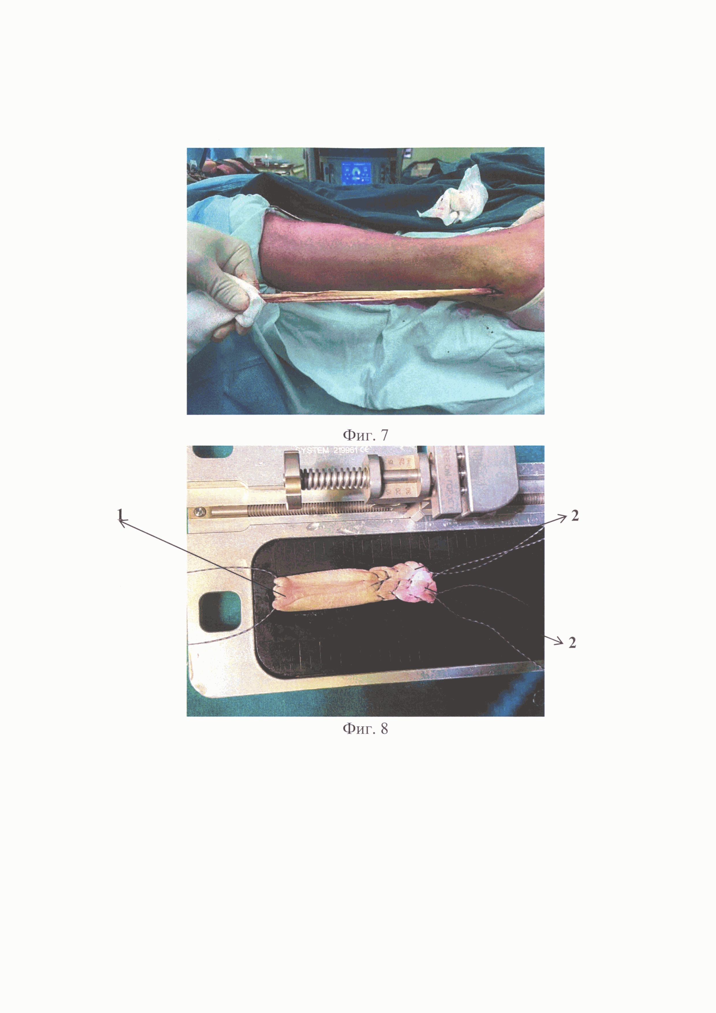Способ хирургического лечения ротаторной артропатии плечевого сустава