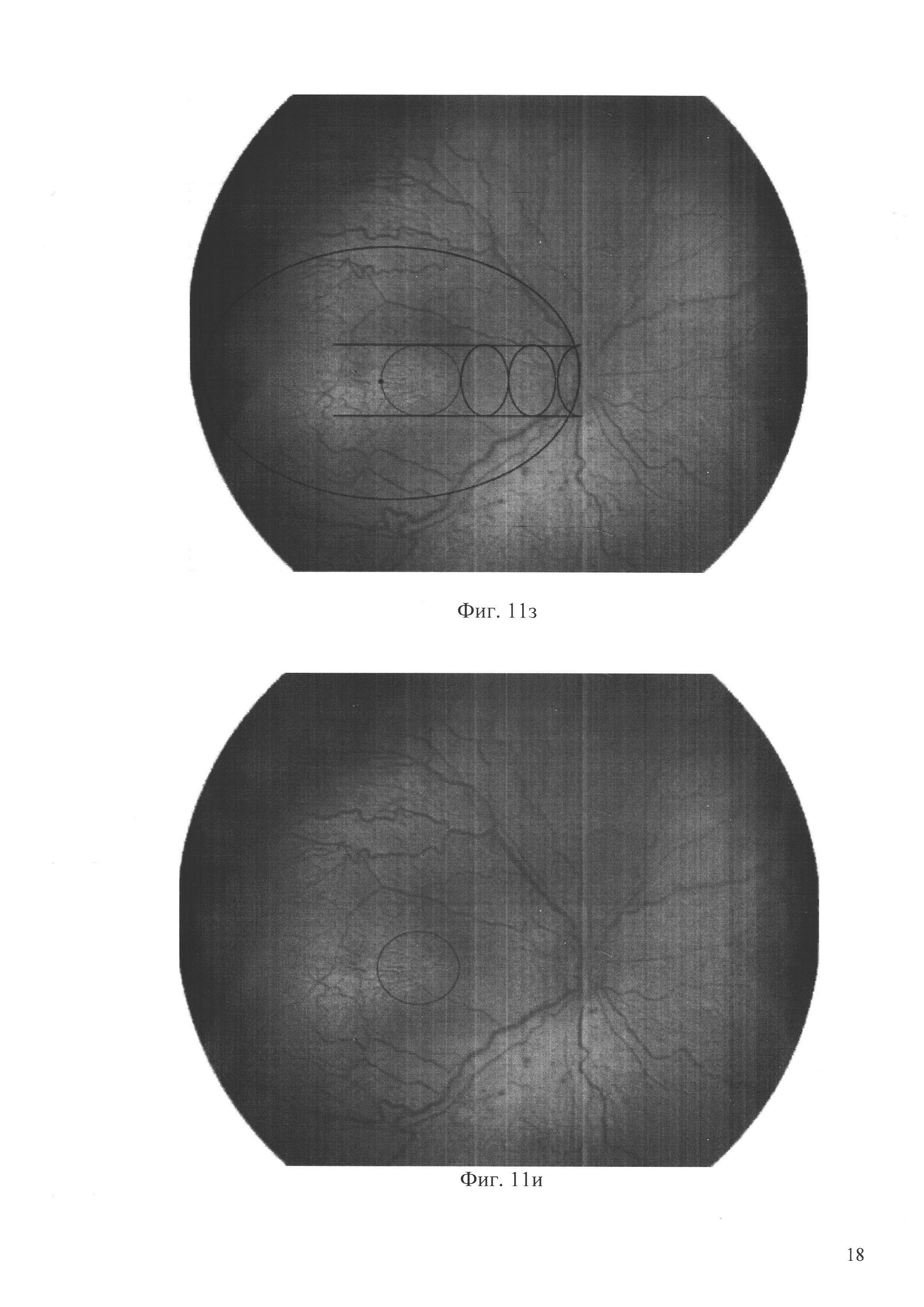 Способ определения локализации макулы при ретинопатии недоношенных (варианты)