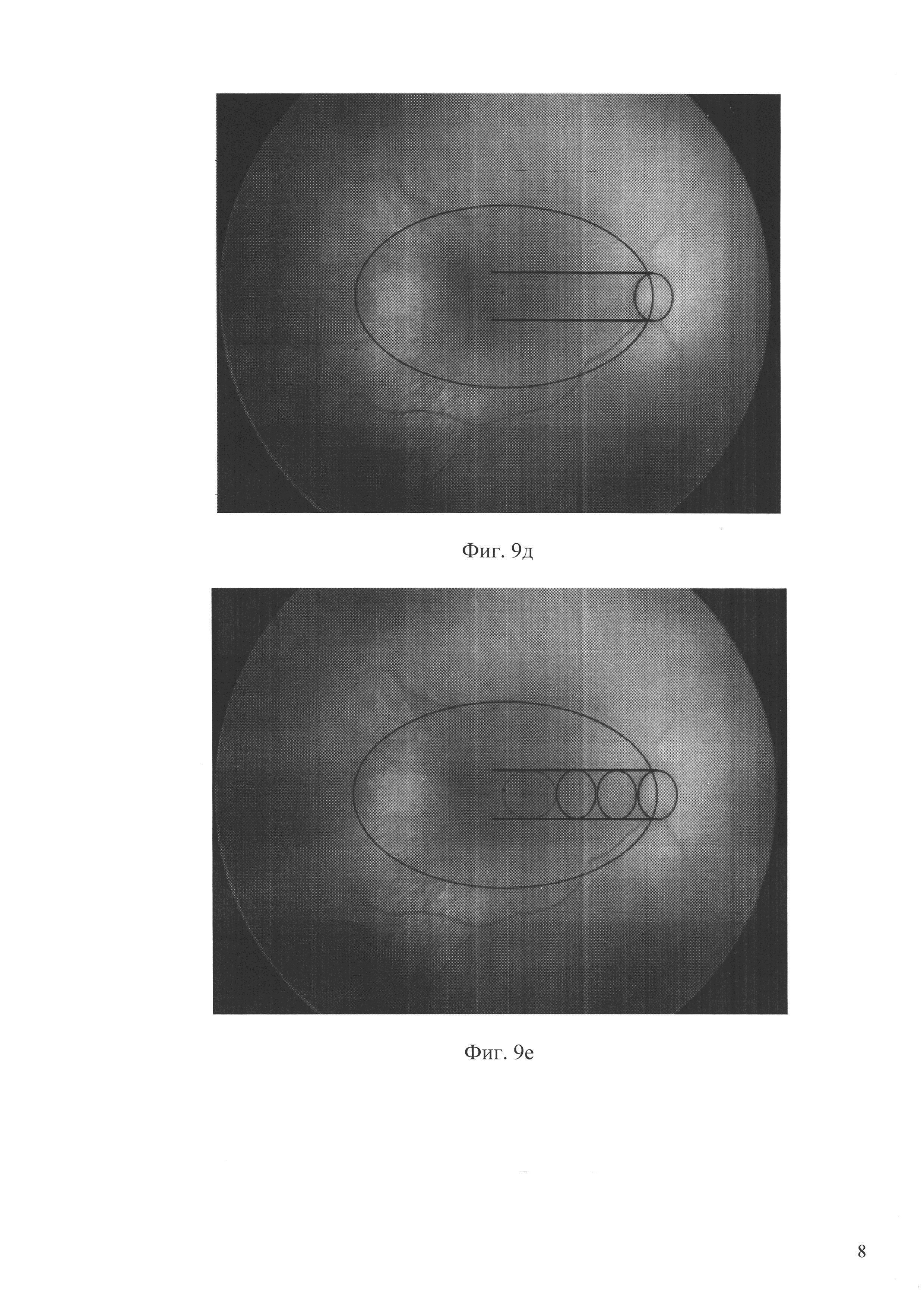 Способ определения локализации макулы при ретинопатии недоношенных (варианты)