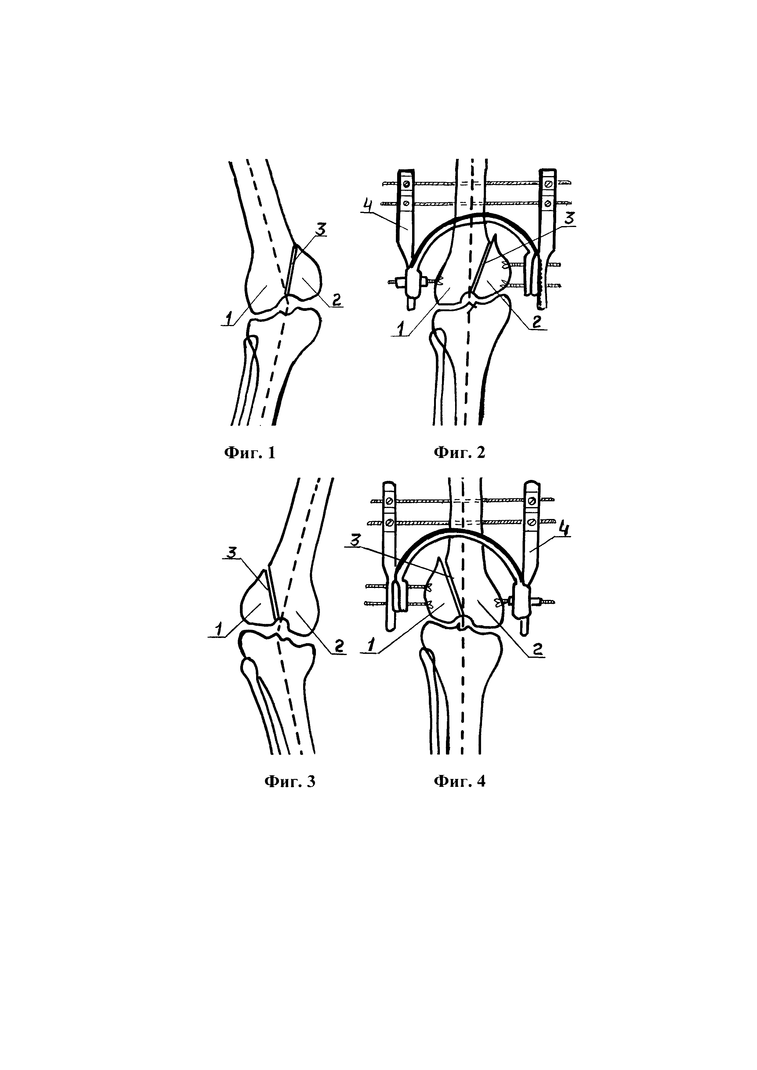 Способ коррекции вальгусно-варусных деформаций коленного сустава