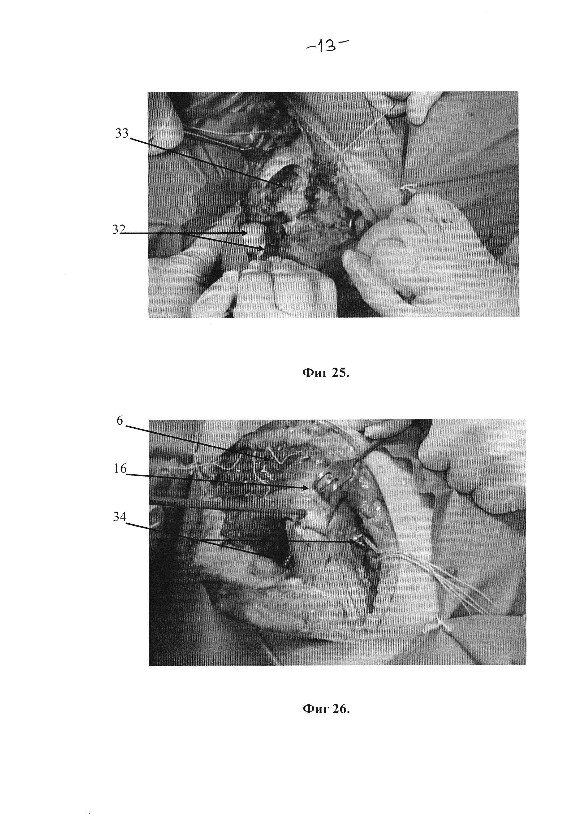 Способ экспериментального анатомо-хирургического обоснования оперативного доступа к тазобедренному суставу при чрезвертлужных переломах костей таза