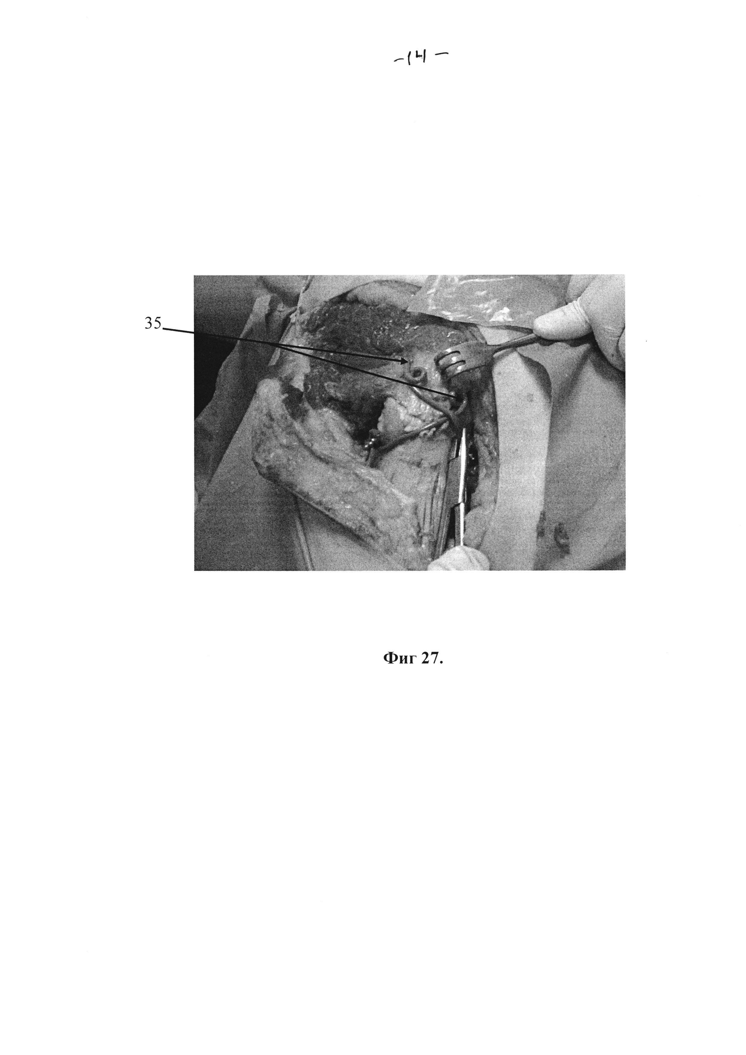 Способ экспериментального анатомо-хирургического обоснования оперативного доступа к тазобедренному суставу при чрезвертлужных переломах костей таза