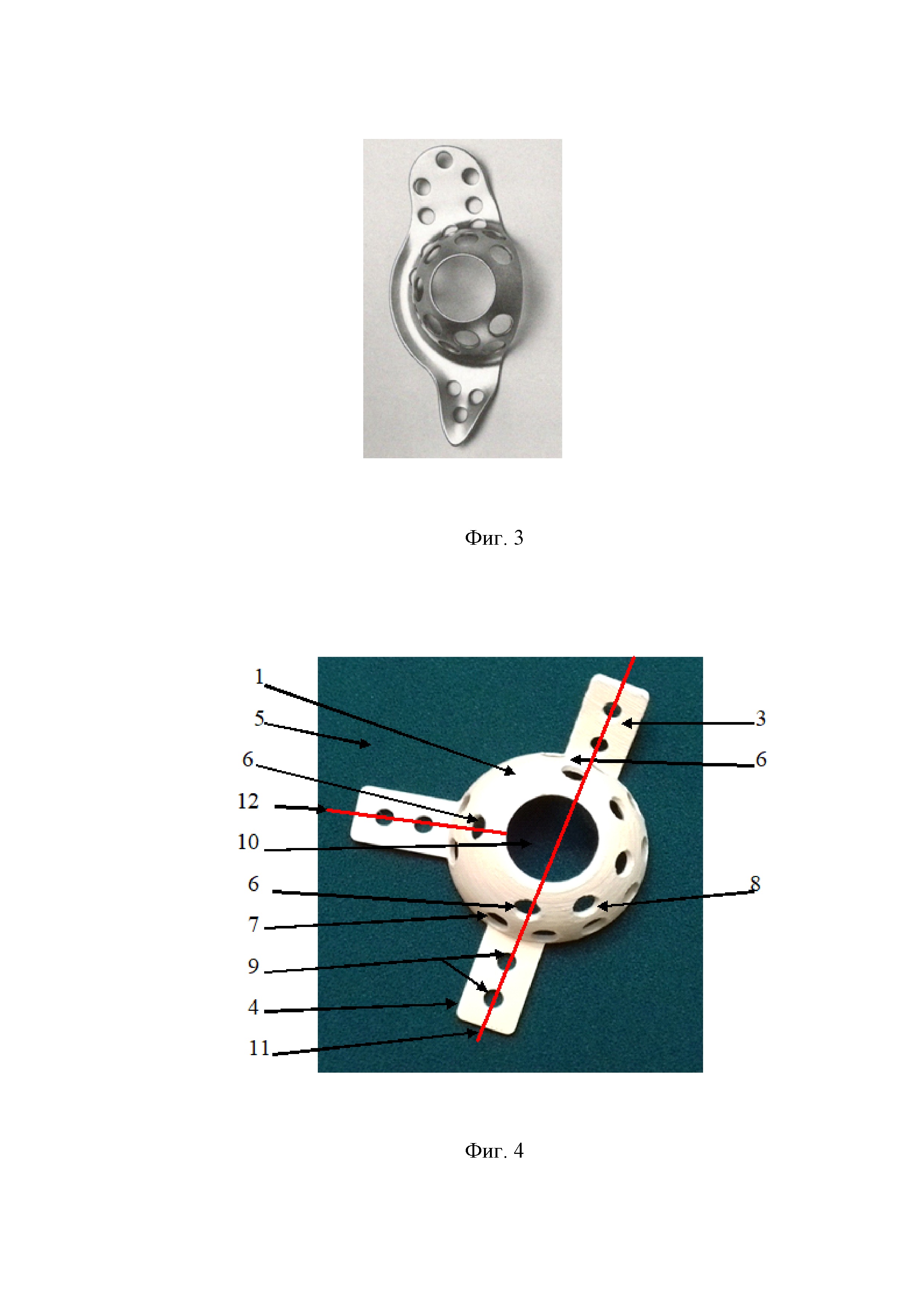 Репозиционно-фиксационное опорное кольцо для оперативного лечения смещенных переломов вертлужной впадины