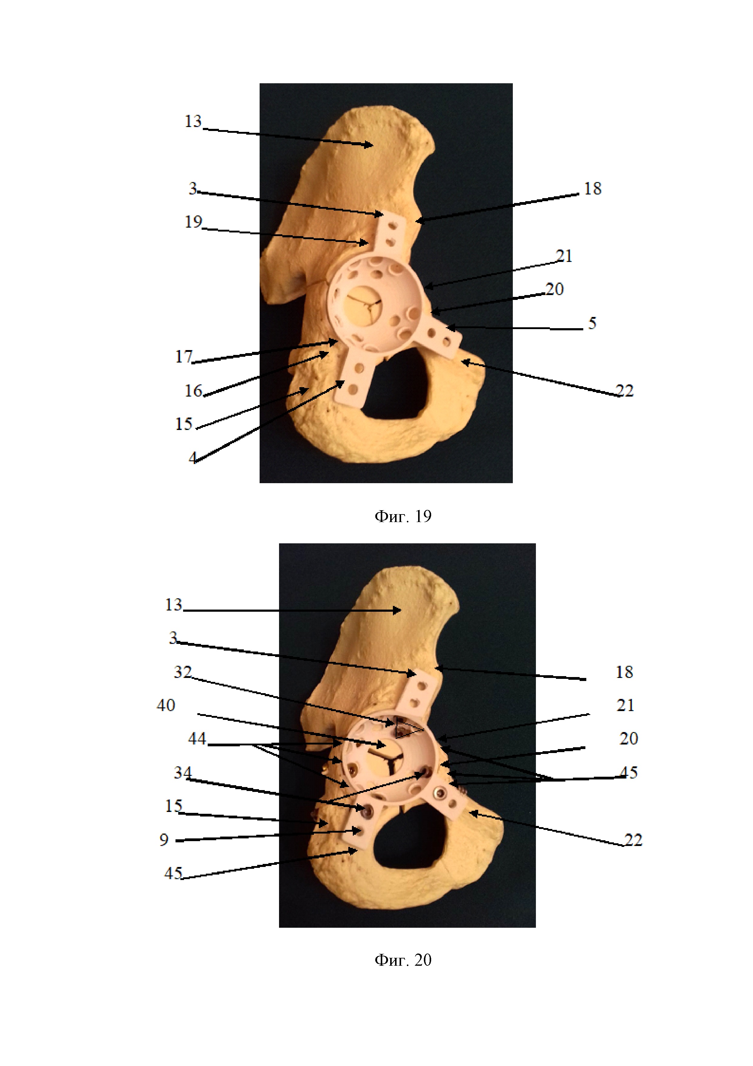 Репозиционно-фиксационное опорное кольцо для оперативного лечения смещенных переломов вертлужной впадины