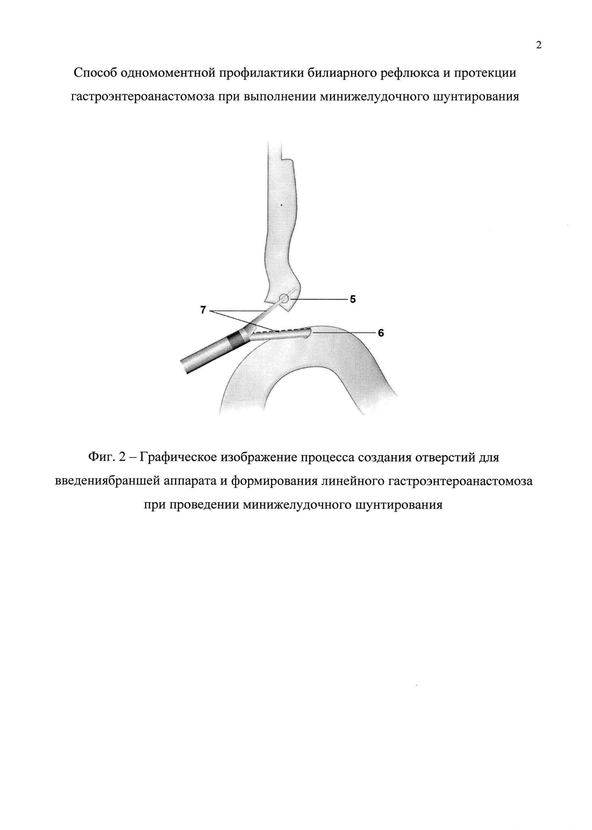 Способ одномоментной профилактики билиарного рефлюкса и протекции гастроэнтероанастомоза при выполнении минижелудочного шунтирования
