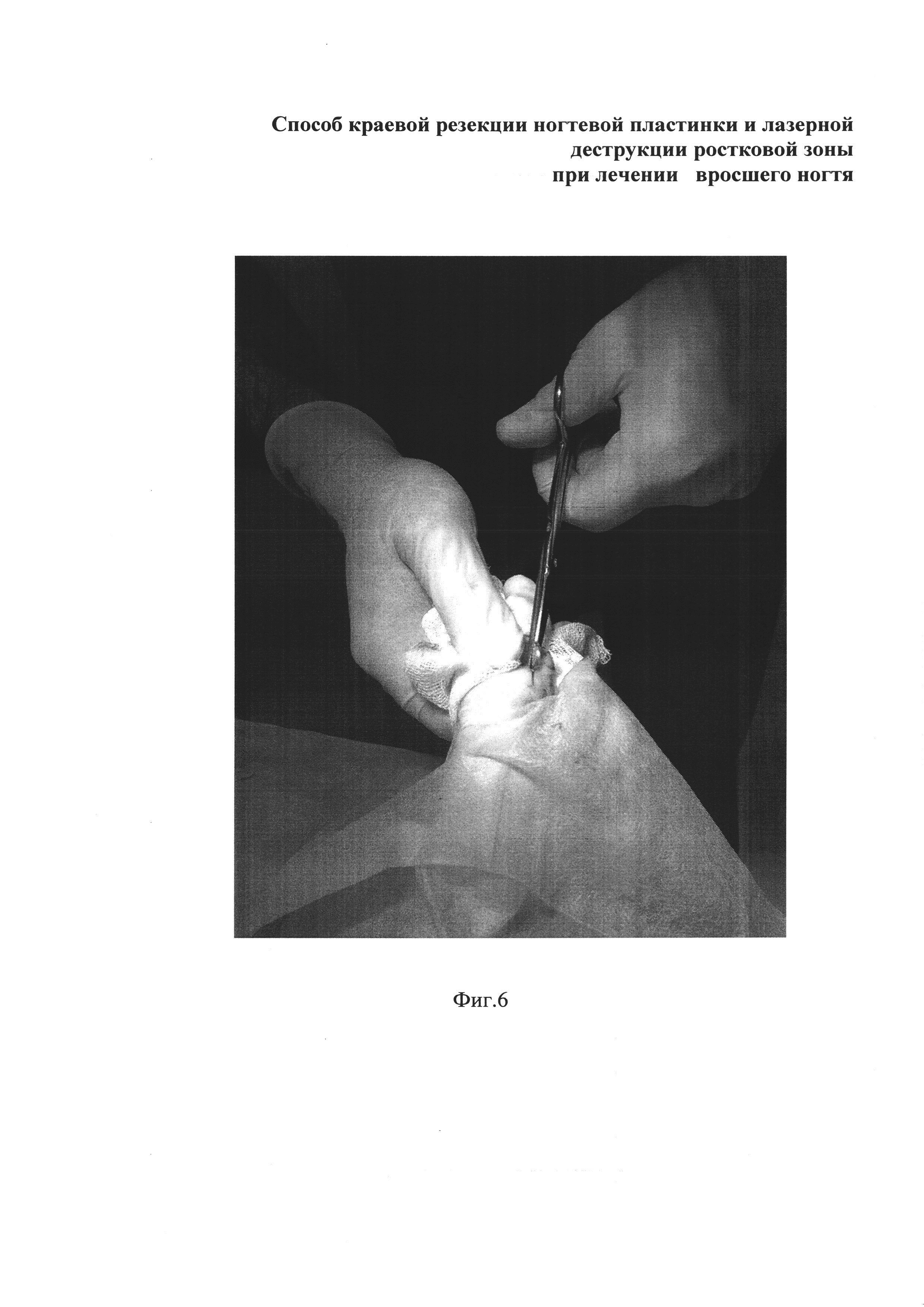 Способ краевой резекции ногтевой пластинки и лазерной деструкции ростковой зоны при лечении вросшего ногтя