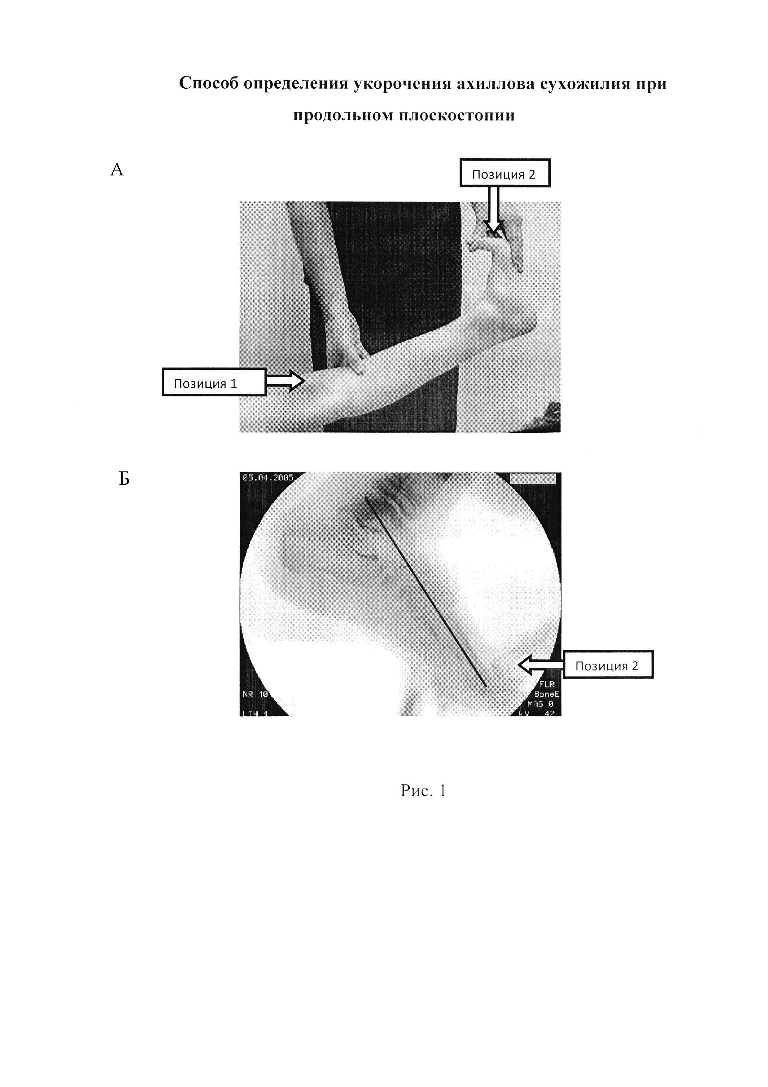 Способ определения укорочения ахиллова сухожилия при продольном плоскостопии
