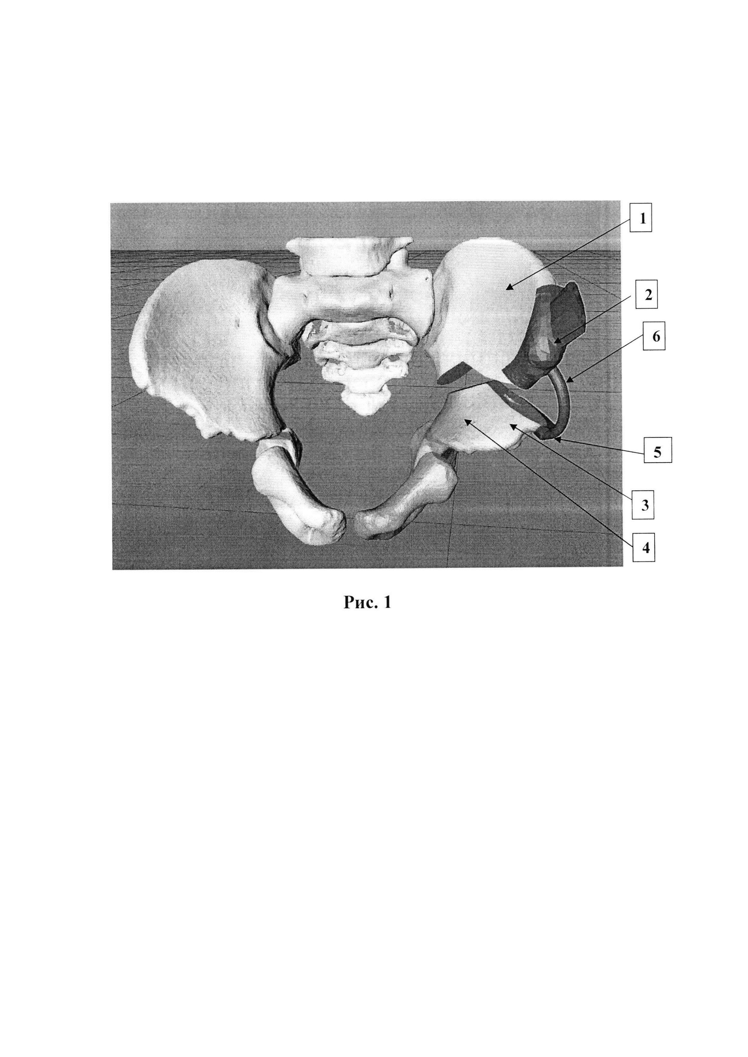Устройство, фиксирующее взаимно пространственную ориентацию костных фрагментов в оптимальном анатомо-функциональном положении в ходе выполнения остеотомии таза при дисплазии тазобедренных суставов