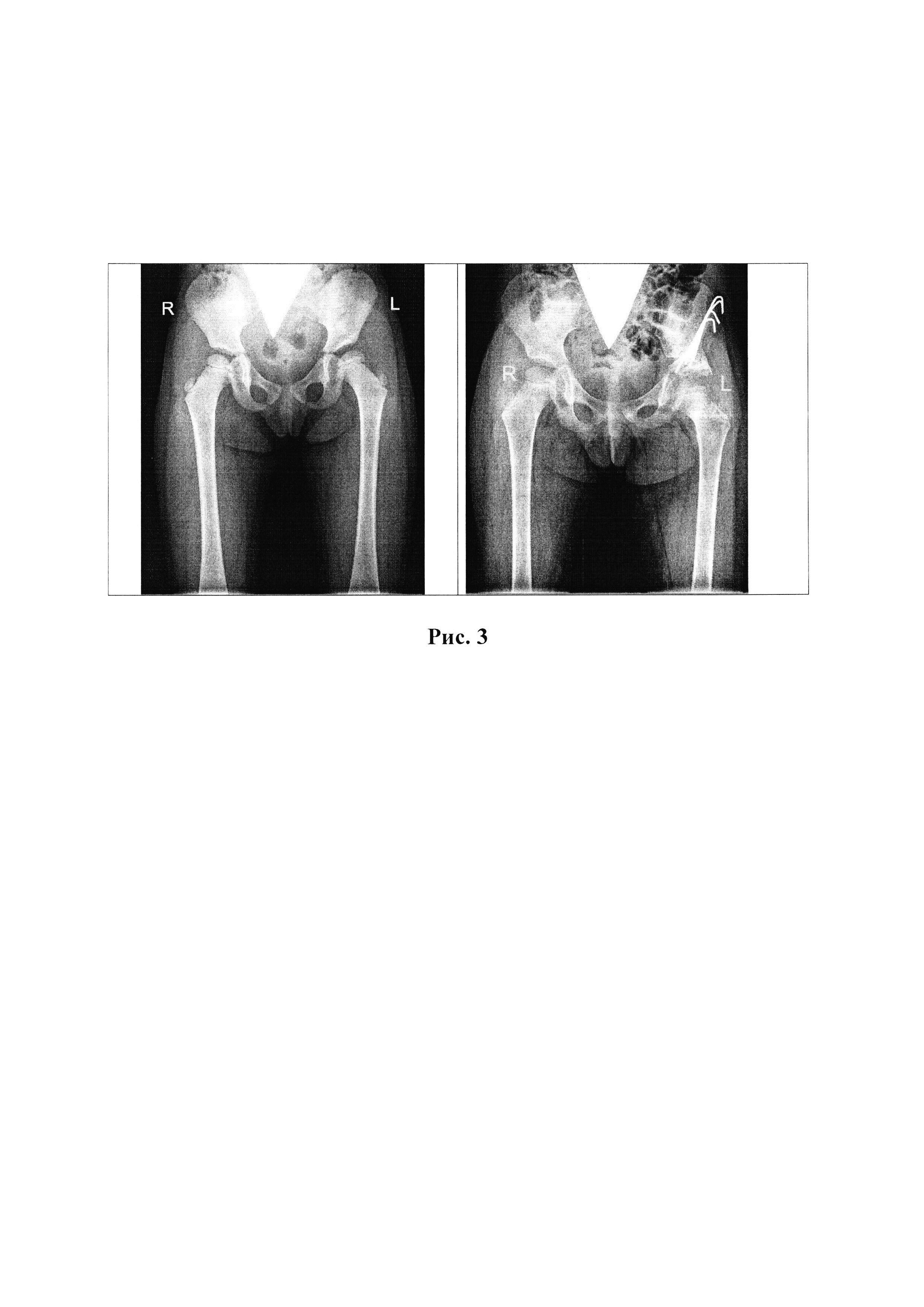 Устройство, фиксирующее взаимно пространственную ориентацию костных фрагментов в оптимальном анатомо-функциональном положении в ходе выполнения остеотомии таза при дисплазии тазобедренных суставов