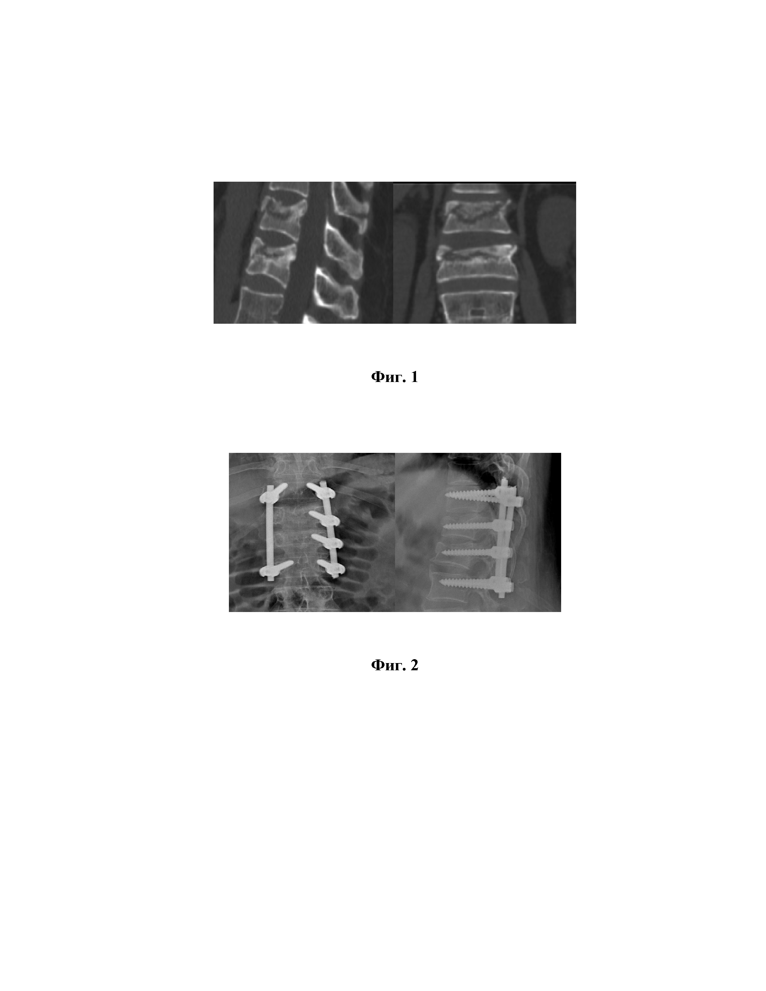 Способ хирургического лечения оскольчатых переломов грудных и поясничных позвонков