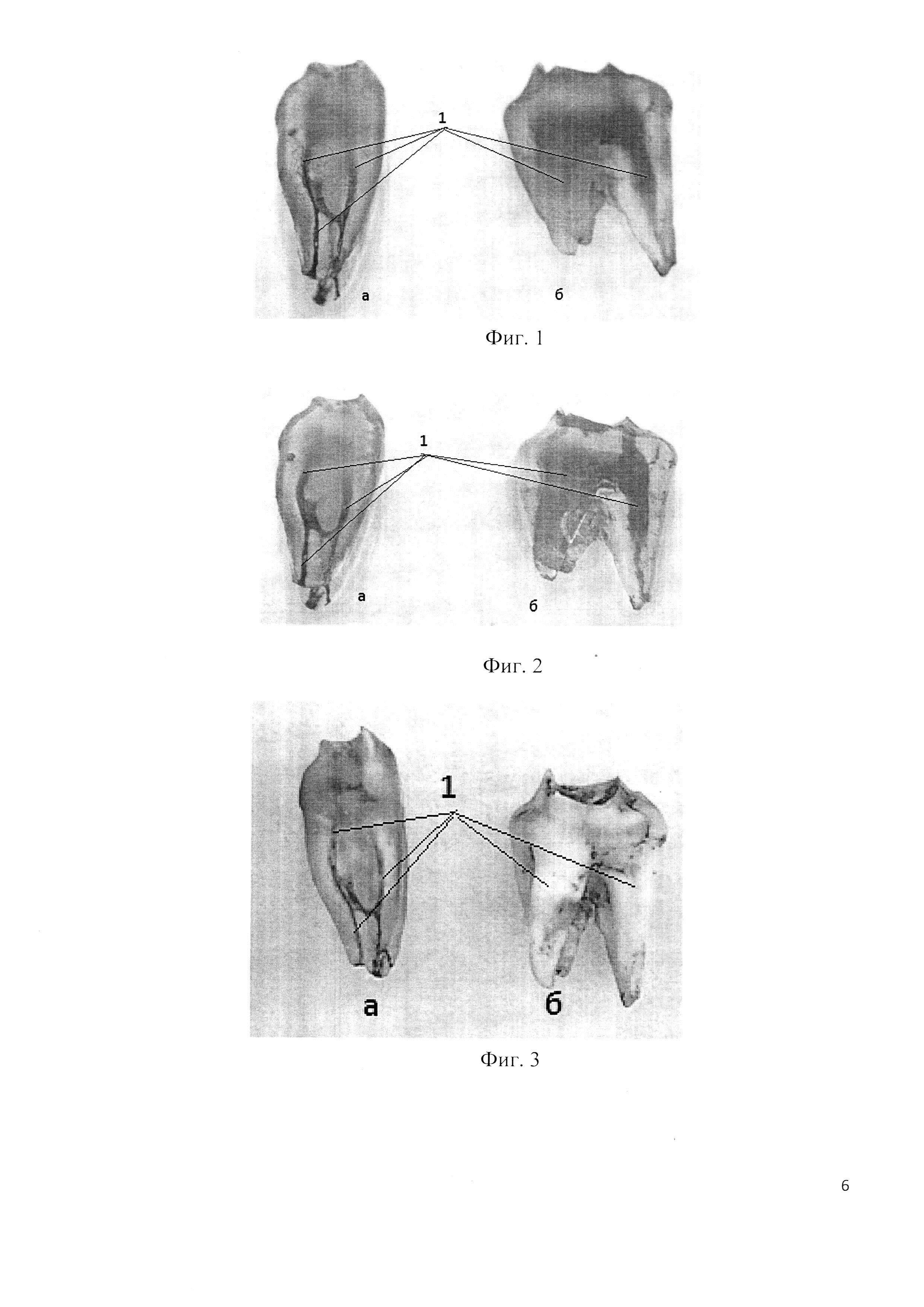 Способ визуализации канала удаленного зуба