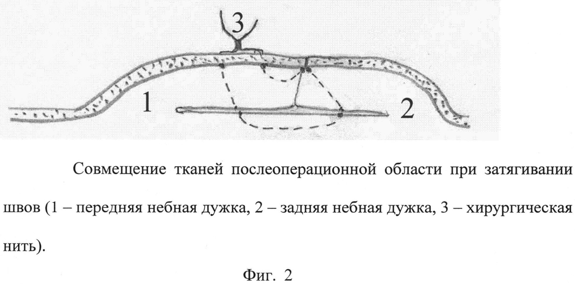 Куф при тонзиллите схема