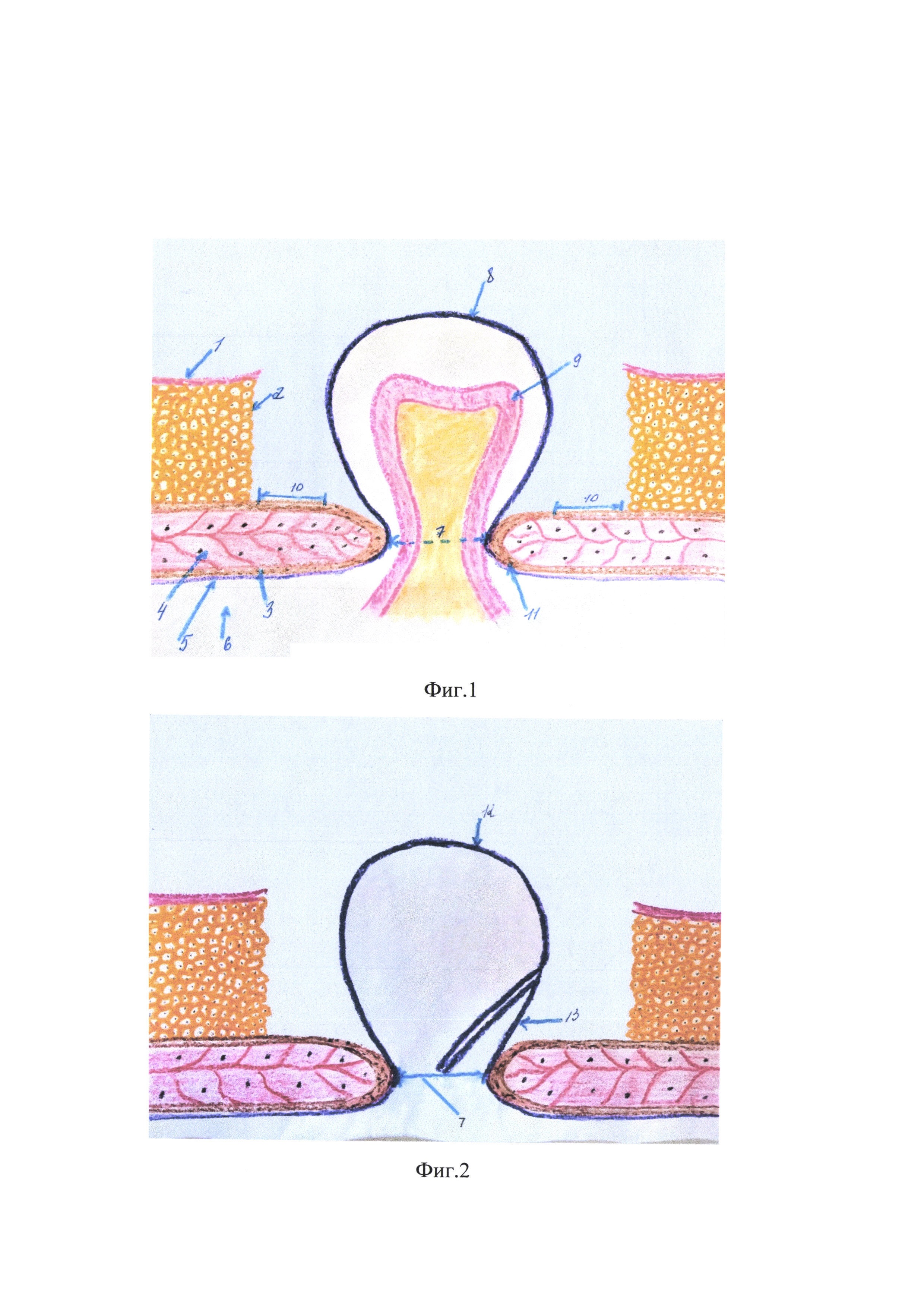 Способ герниопластики обширных и гигантских послеоперационных вентральных грыж
