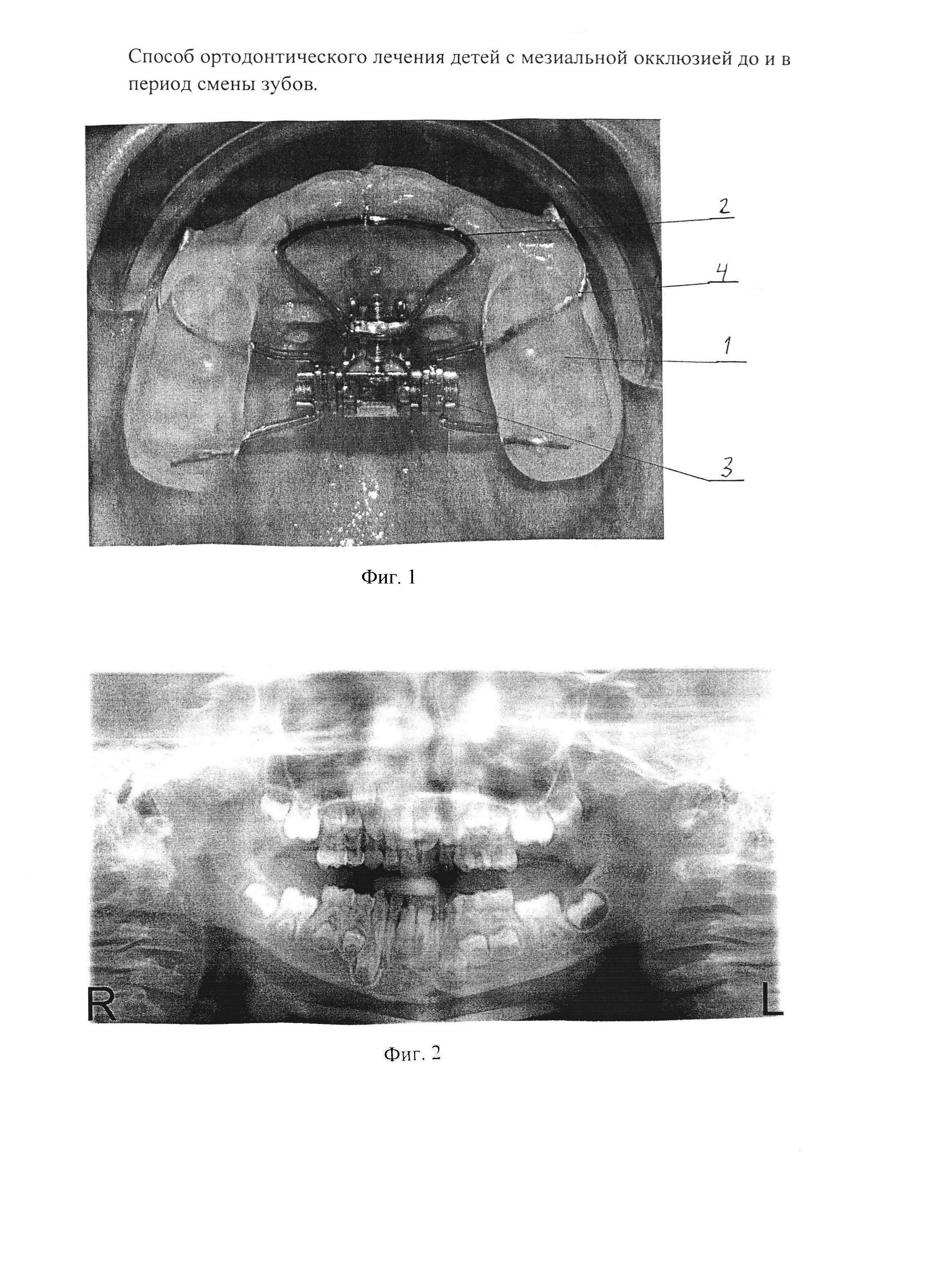 Способ ортодонтического лечения детей с мезиальной окклюзией до и в период смены зубов