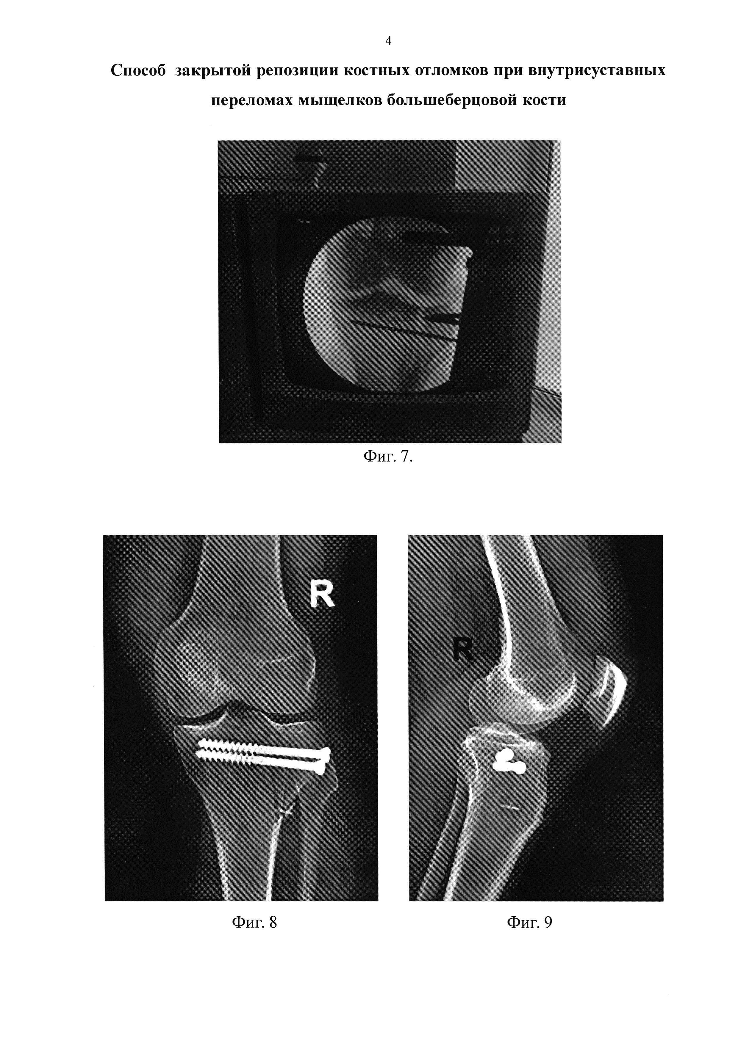 Способ закрытой репозиции костных отломков при внутрисуставных переломах мыщелков большеберцовой кости