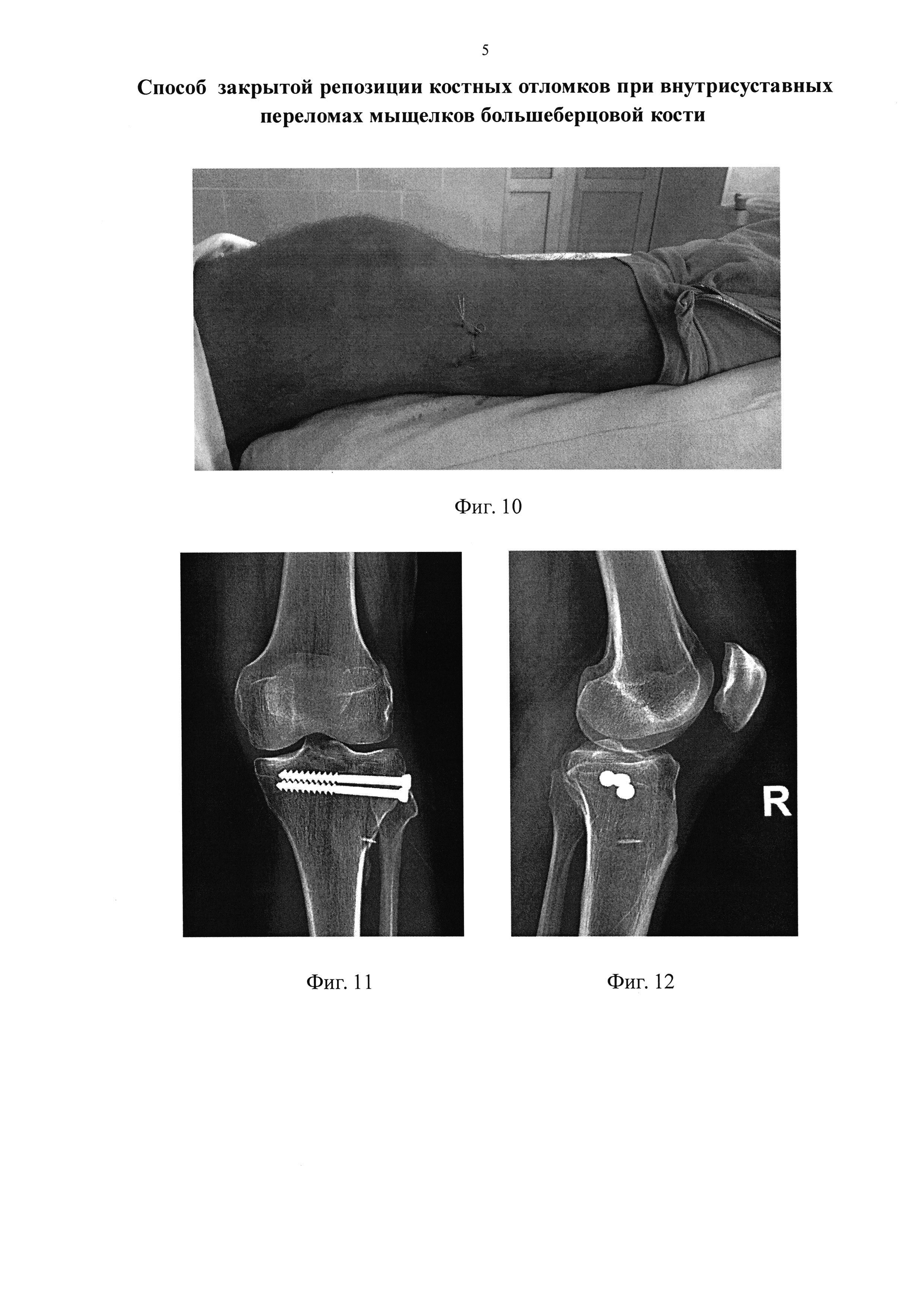 Способ закрытой репозиции костных отломков при внутрисуставных переломах мыщелков большеберцовой кости