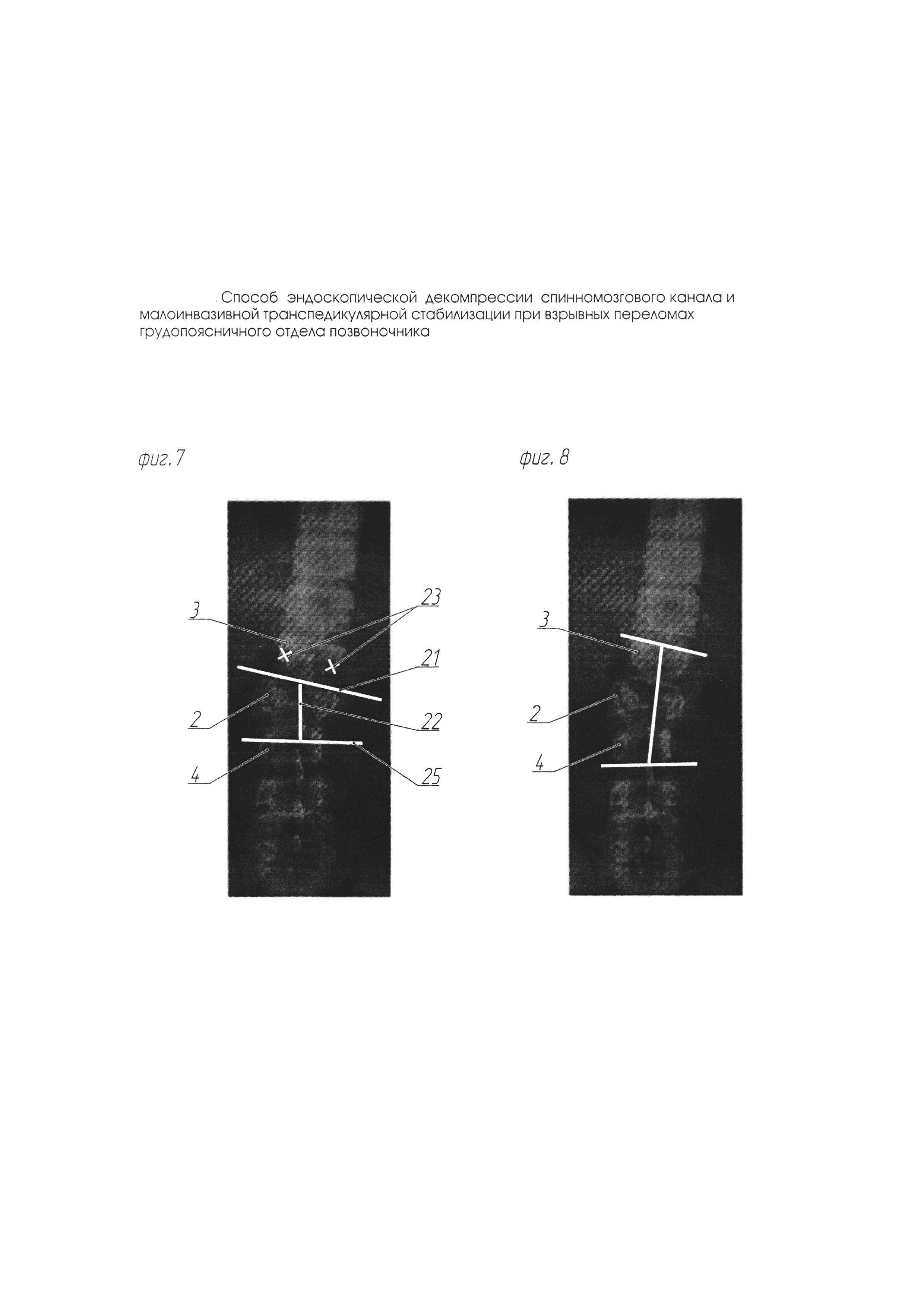 Способ эндоскопической декомпрессии спинномозгового канала и малоинвазивной транспедикулярной стабилизации при взрывных переломах грудопоясничного отдела позвоночника
