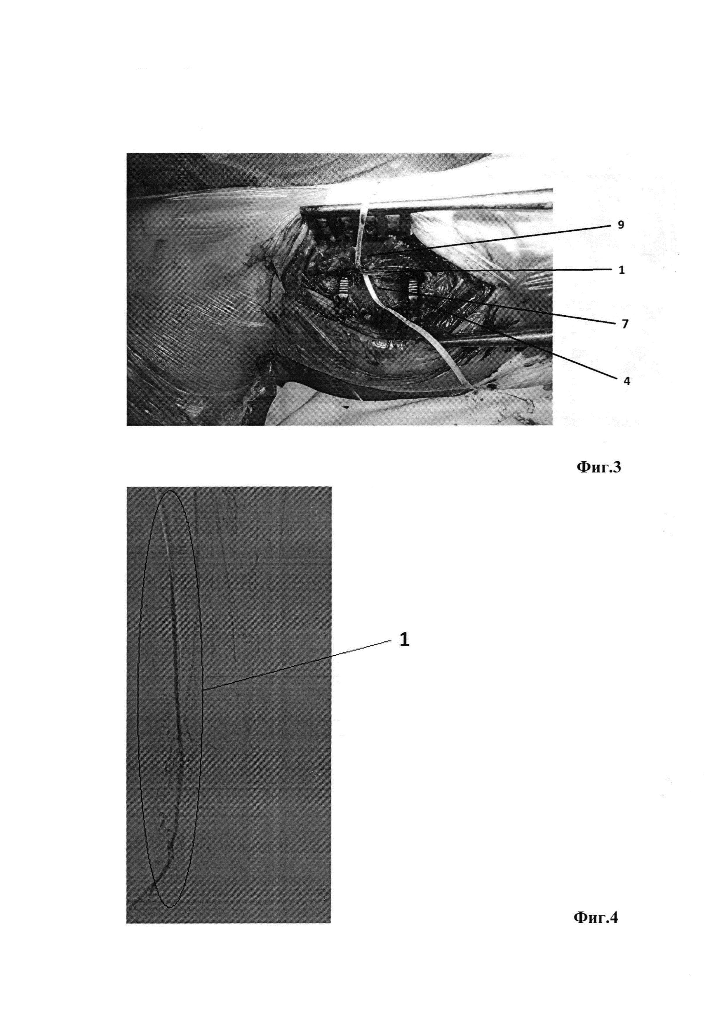 Способ оперативного доступа для выделения и шунтирования передней большеберцовой артерии