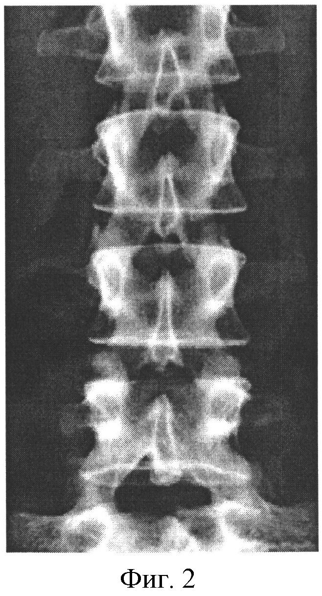 Как делают рентген поясничного отдела позвоночника