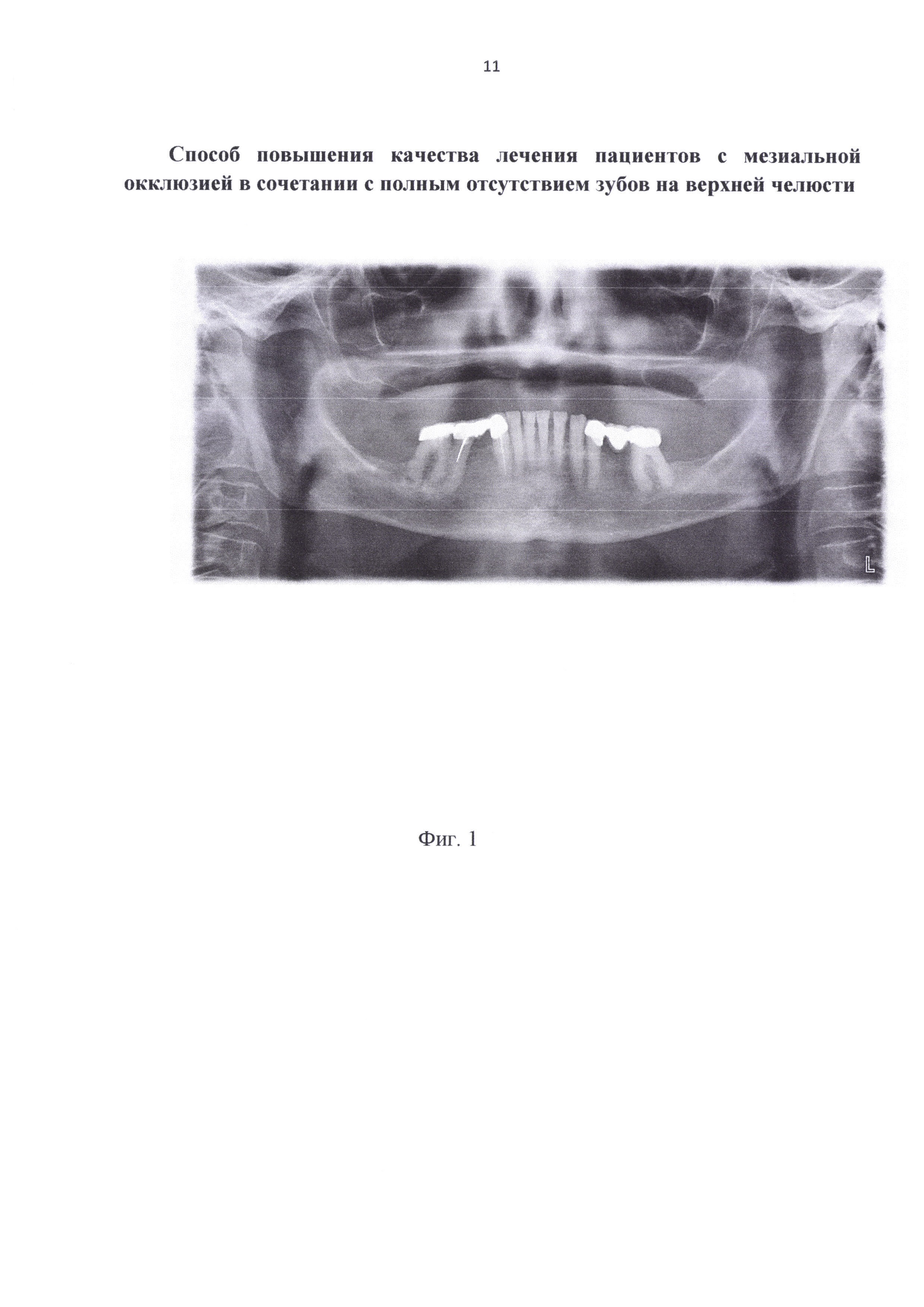 Способ повышения качества лечения пациентов с мезиальной окклюзией в сочетании с полным отсутствием зубов на верхней челюсти