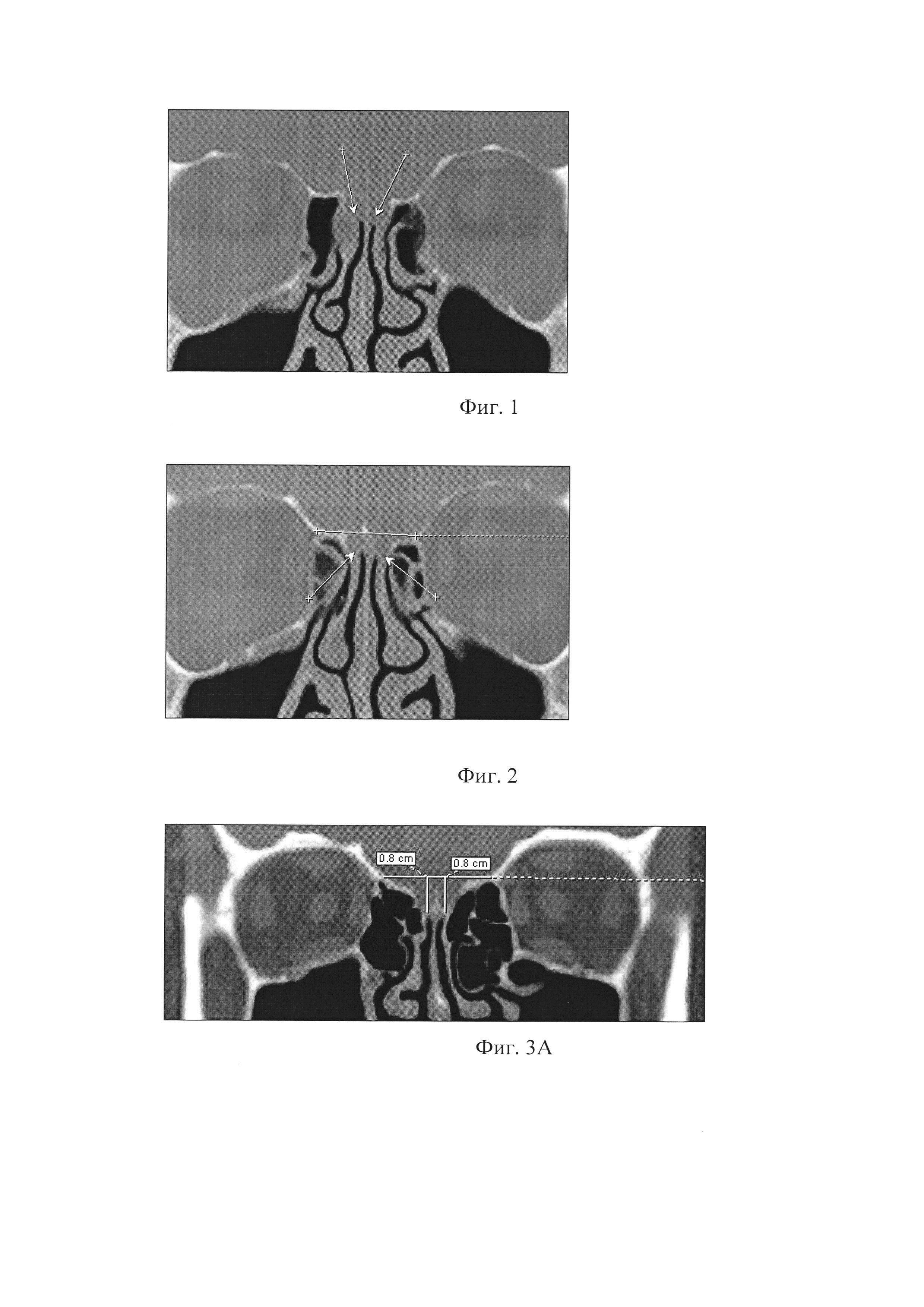 Способ прогнозирования риска перфорации крыши носа при эндоскопических эндоназальных хирургических вмешательствах