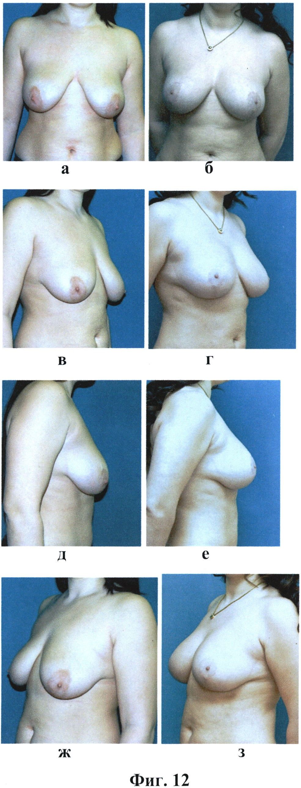тубулярная форма груди у женщин фото 110