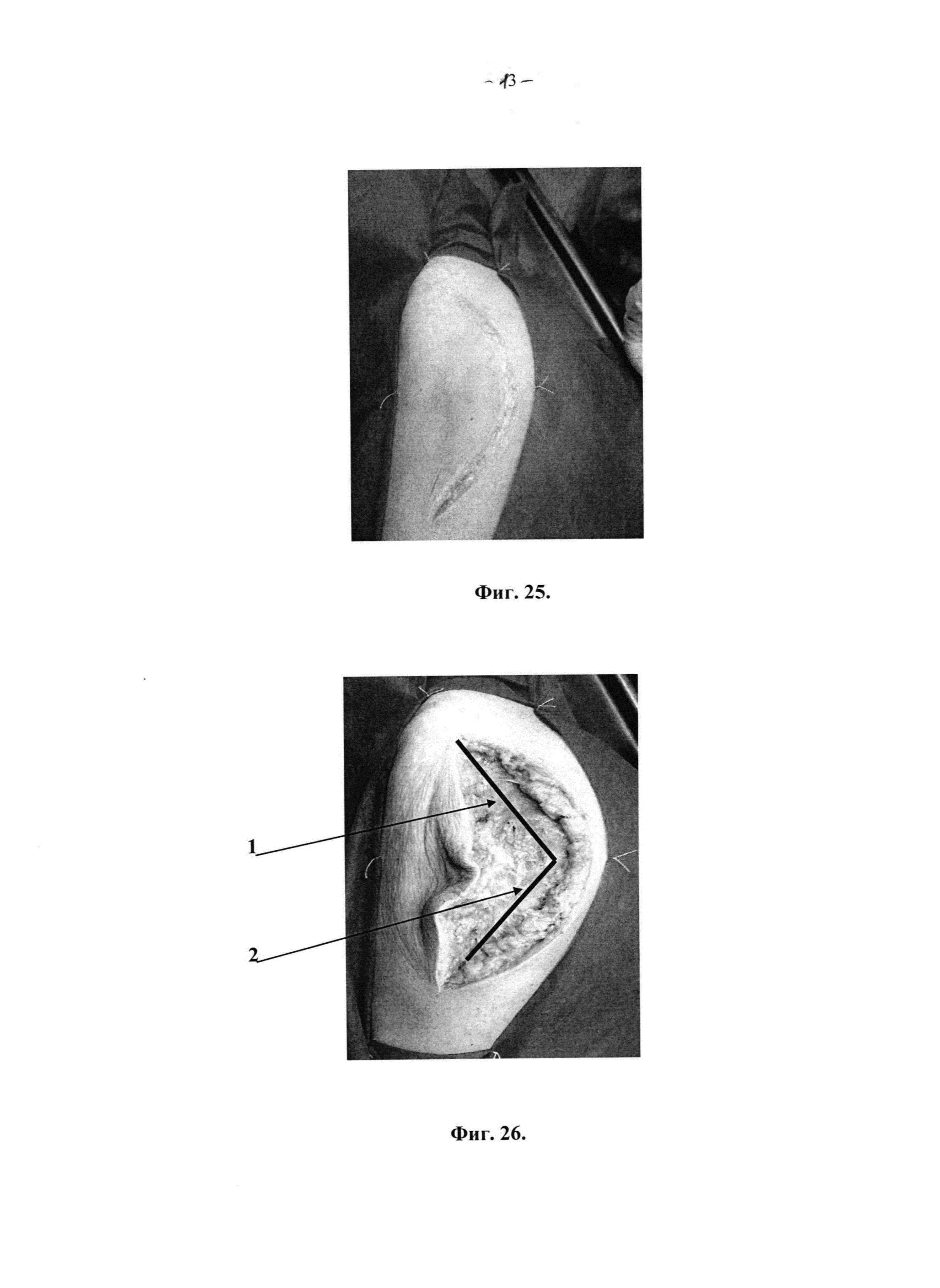 Способ экспериментального хирургического доступа к тазобедренному суставу при переломах вертлужной впадины