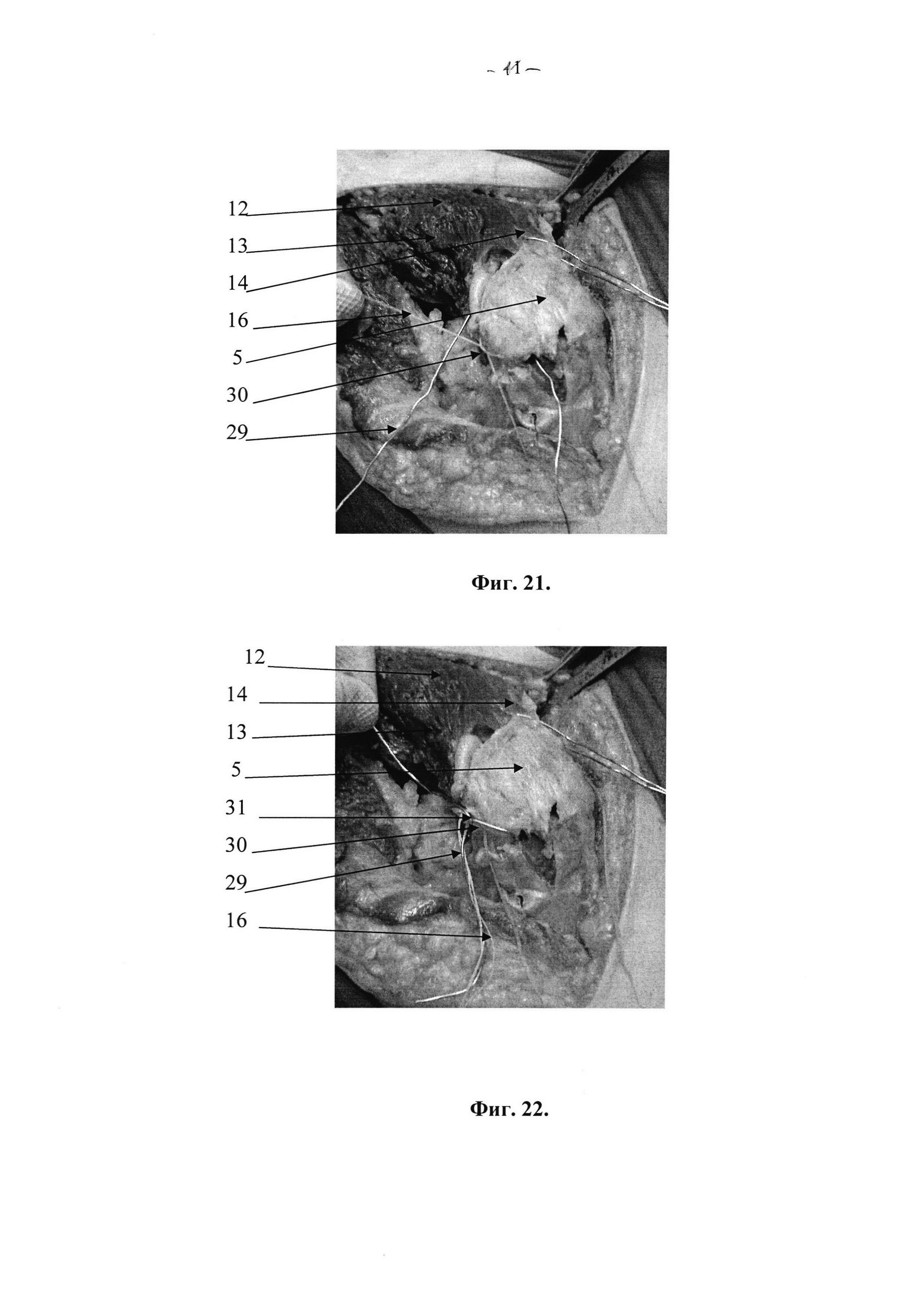 Способ экспериментального хирургического доступа к тазобедренному суставу при переломах вертлужной впадины