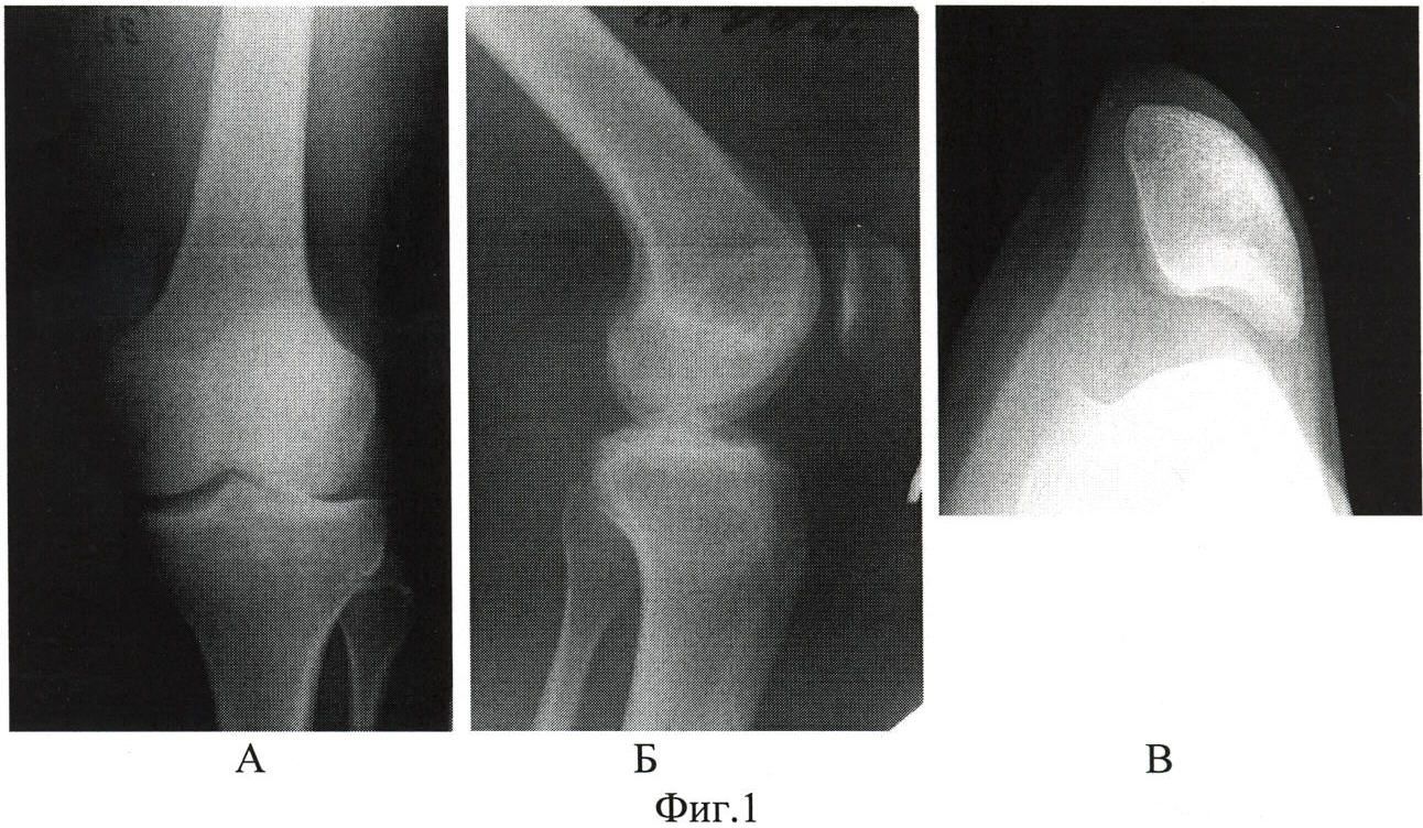 Перелом надколенника операция. Врожденный вывих надколенника рентген. Вертикальный вывих надколенника рентген. Рентген коленного сустава надколенника вывих. Диспластический вывих надколенника.