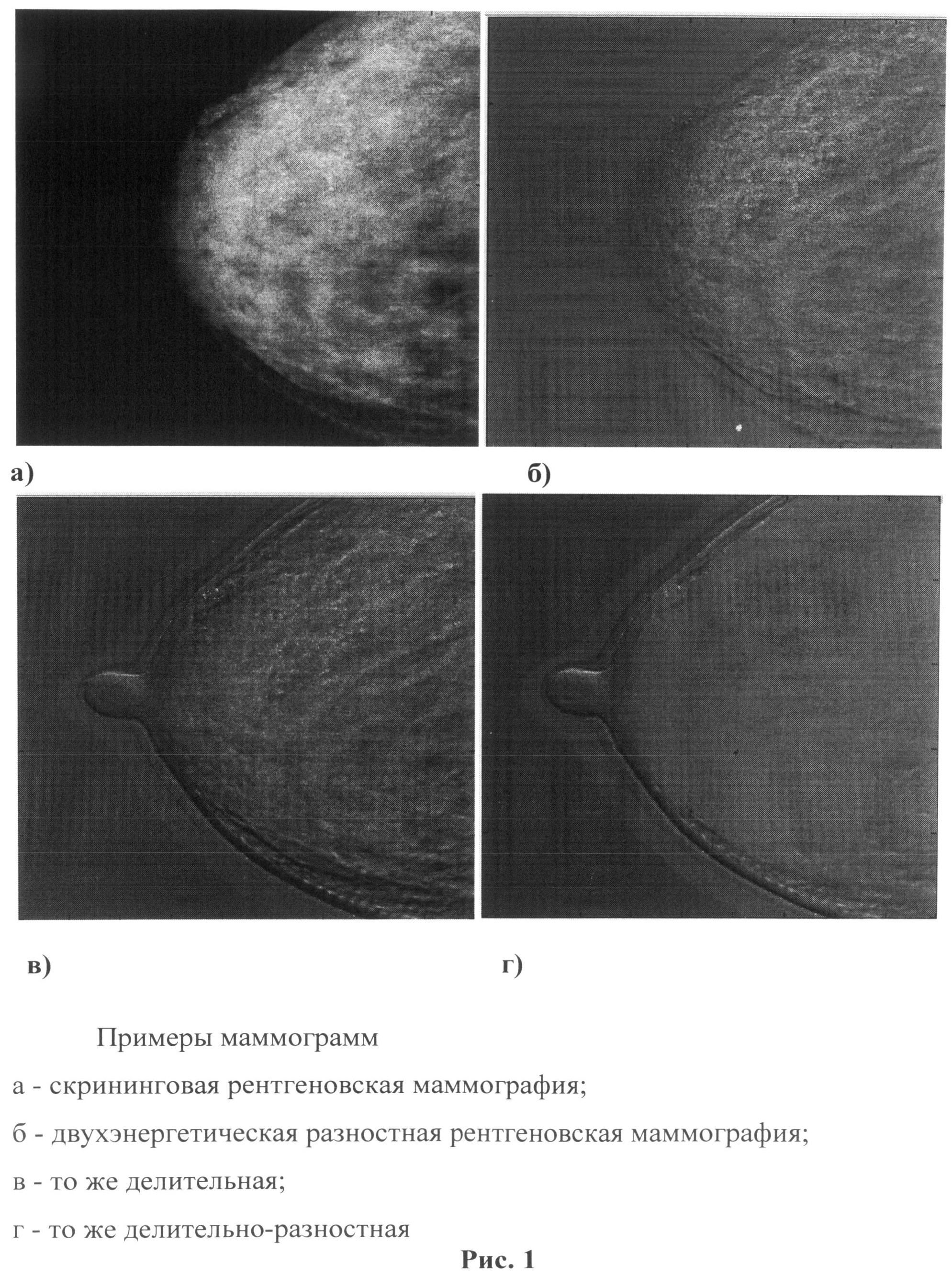 Двухэнергетическая маммография