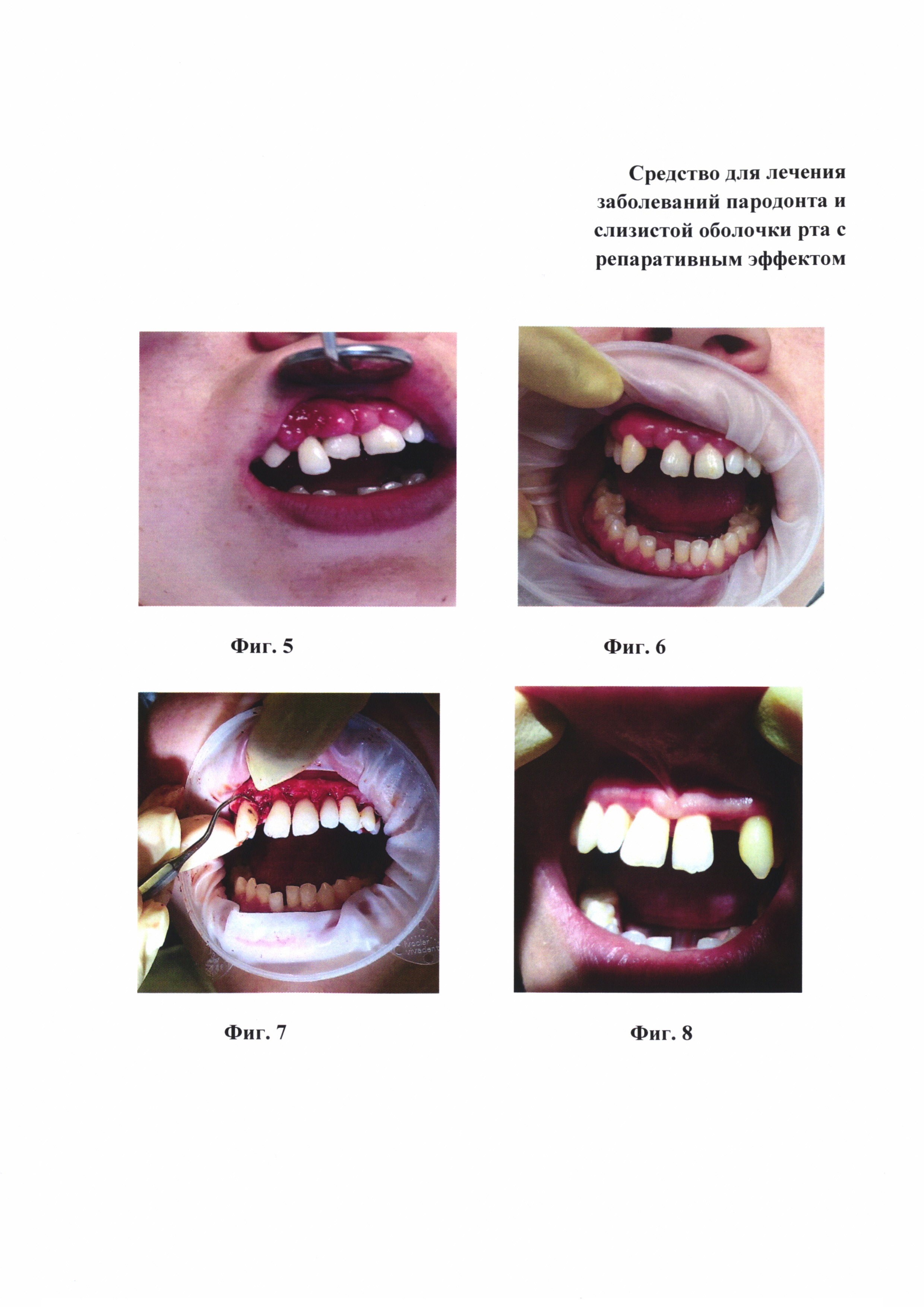 Средство для лечения заболеваний пародонта и слизистой оболочки рта с репаративным эффектом