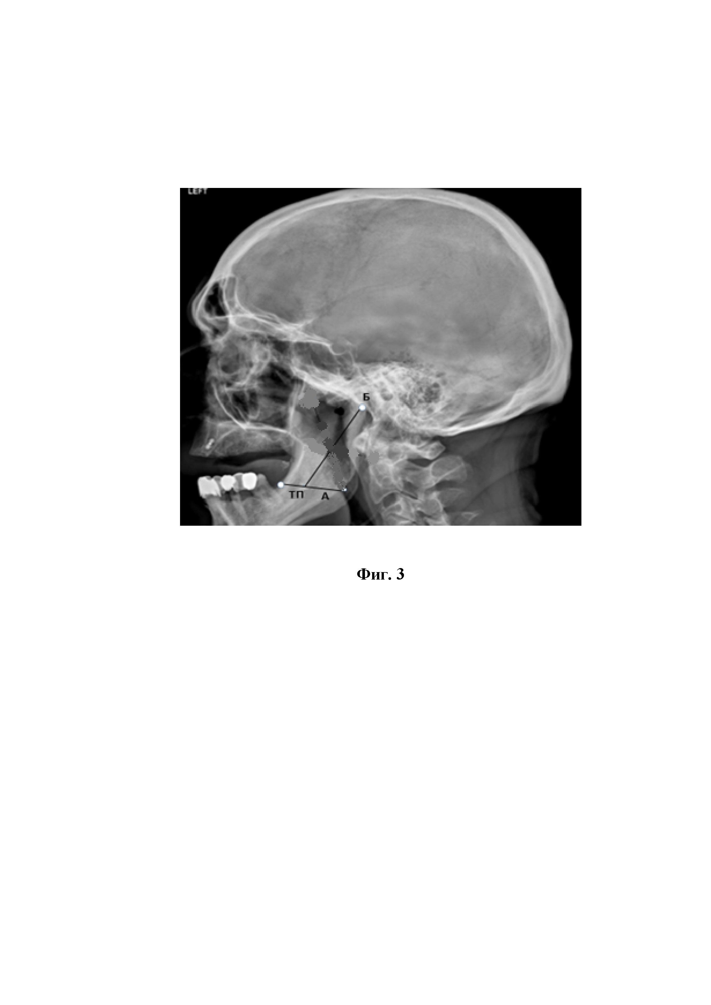 Способ определения расположения канала нижней челюсти для пункции и канюляции нижнего альвеолярного нерва