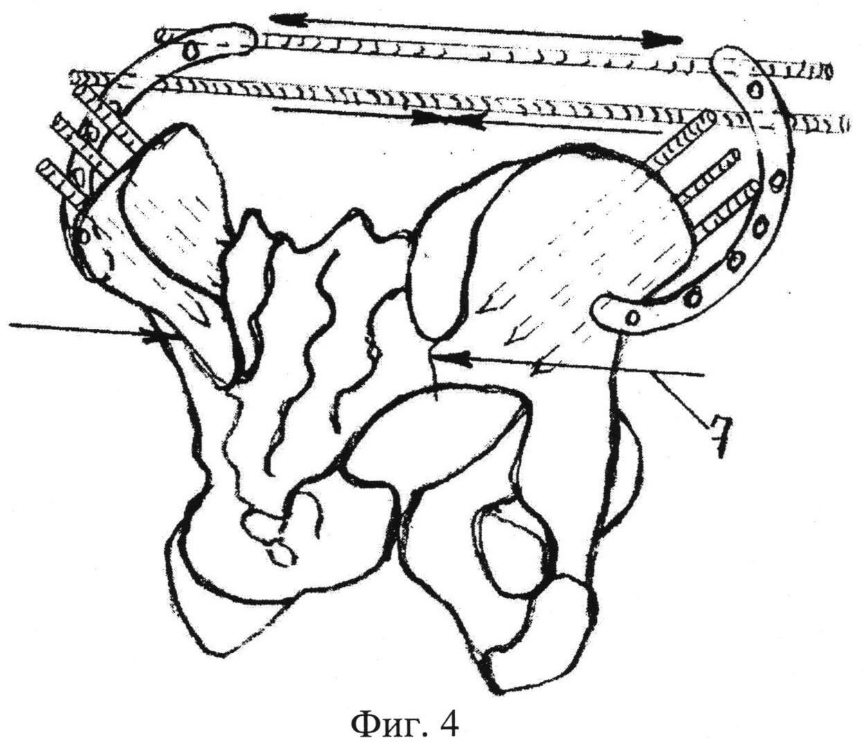 Крестец подвздошная кость. Артродезирование крестцово подвздошного сочленения. Аппарат внешней фиксации на таз. Крестцово-подвздошный сустав. Мышцы крестцово подвздошного сочленения.