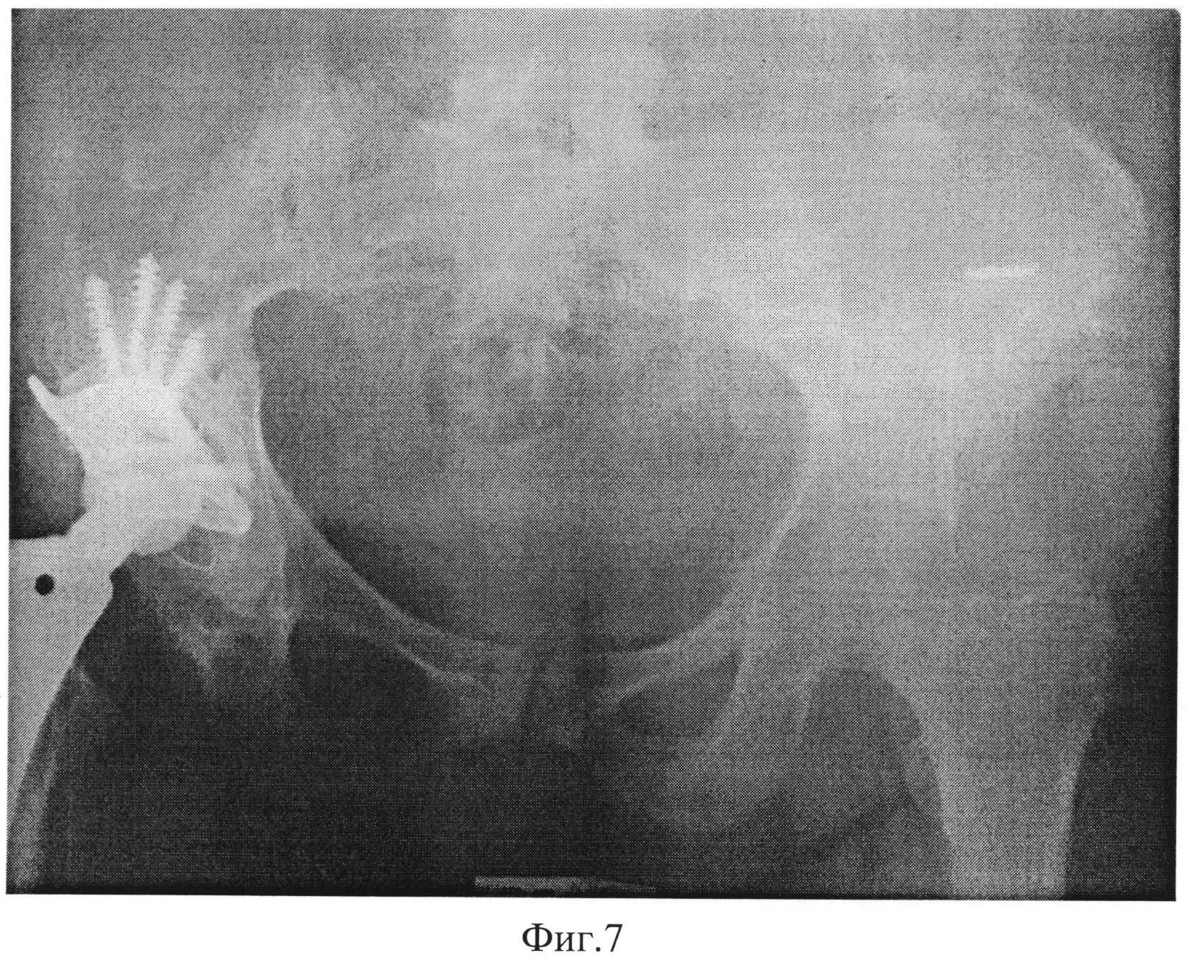Как выглядит сакроилеит на рентгене фото