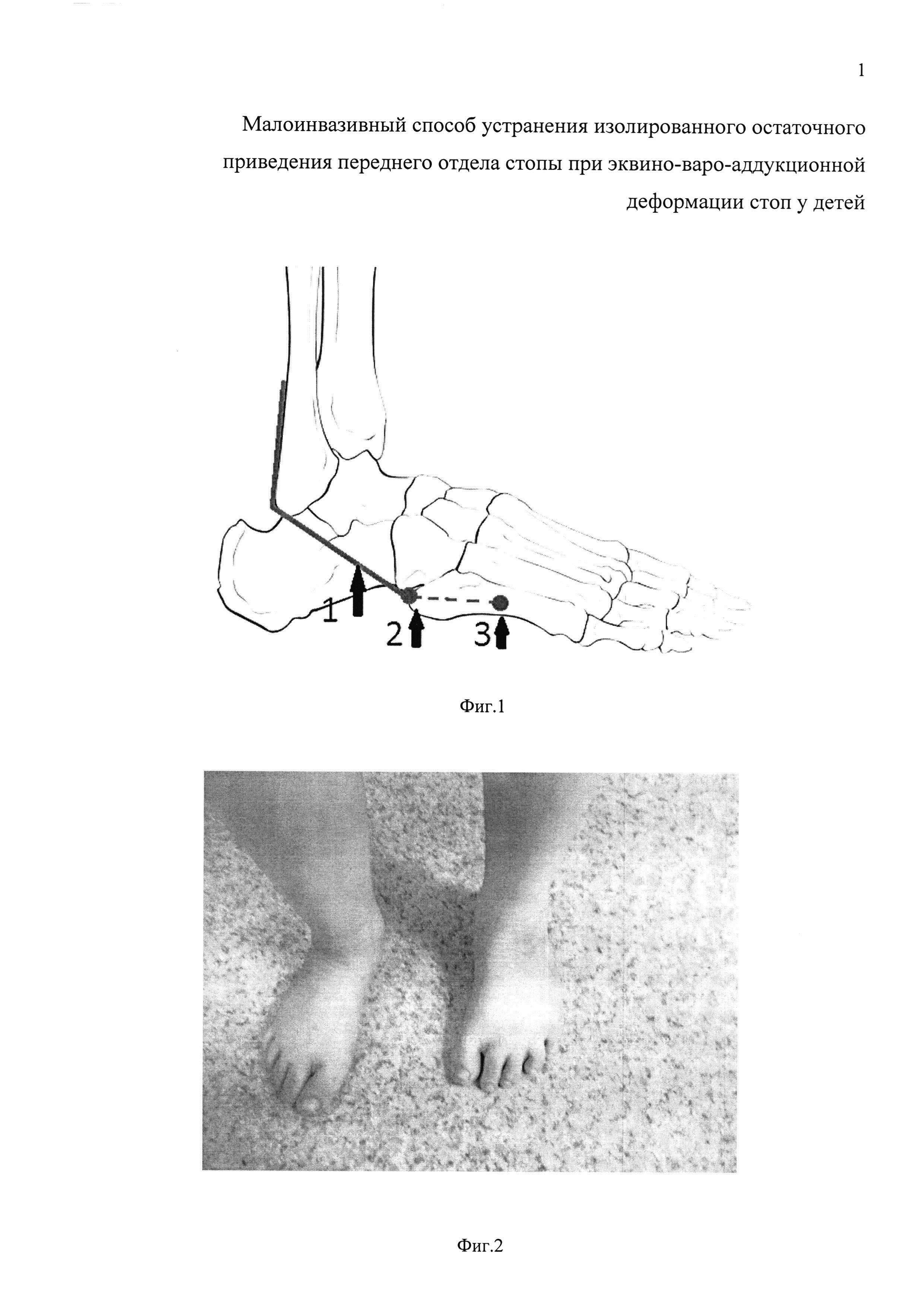 Малоинвазивный способ устранения изолированного остаточного приведения переднего отдела стопы при эквино-варо-аддукционной деформации стоп у детей