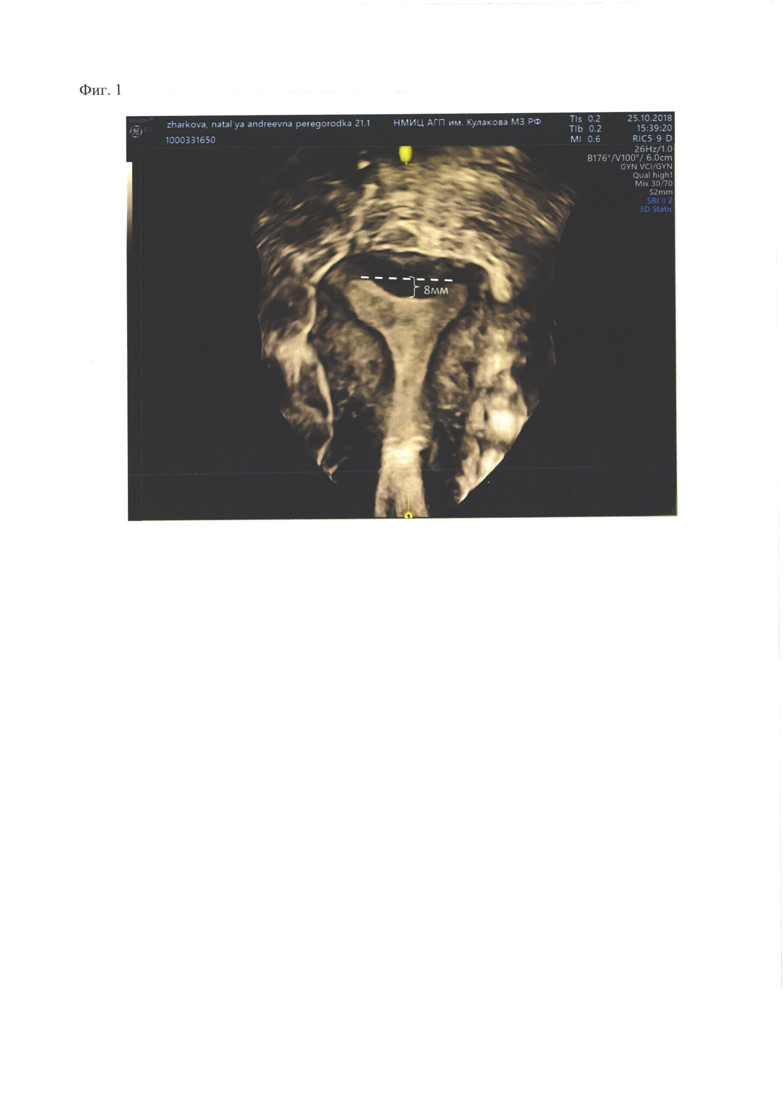 Метод 3D ультразвукового сканирования матки для дифференциации внутриматочной перегородки седловидной формы и определения сосудистого кровотока с целью оперативного лечения